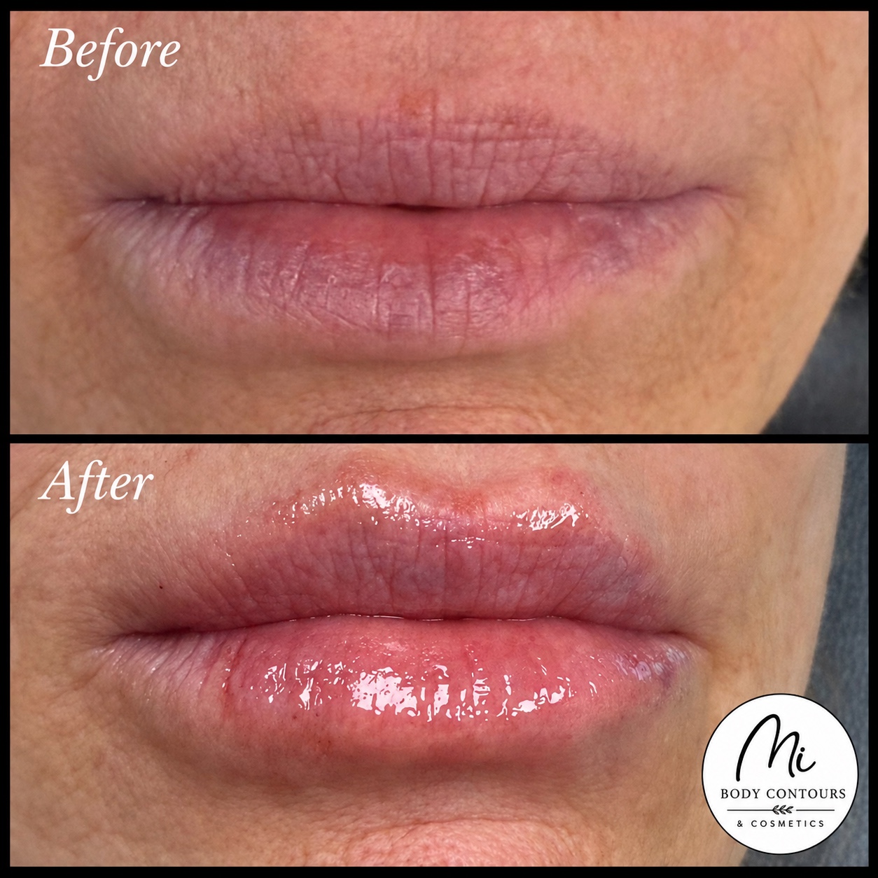 Lip filler before and after — real MI Body Contours patient. Individual results vary.