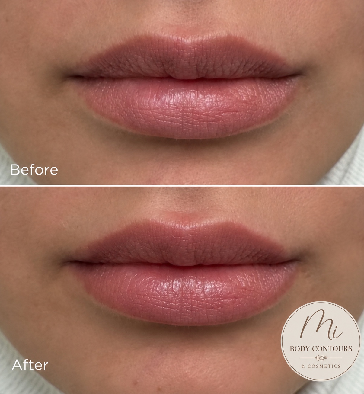 Lip filler before and after — real MI Body Contours patient. Individual results vary.