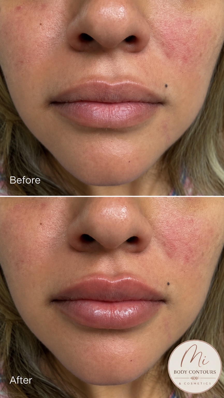 Lip filler before and after — real MI Body Contours patient. Individual results vary.