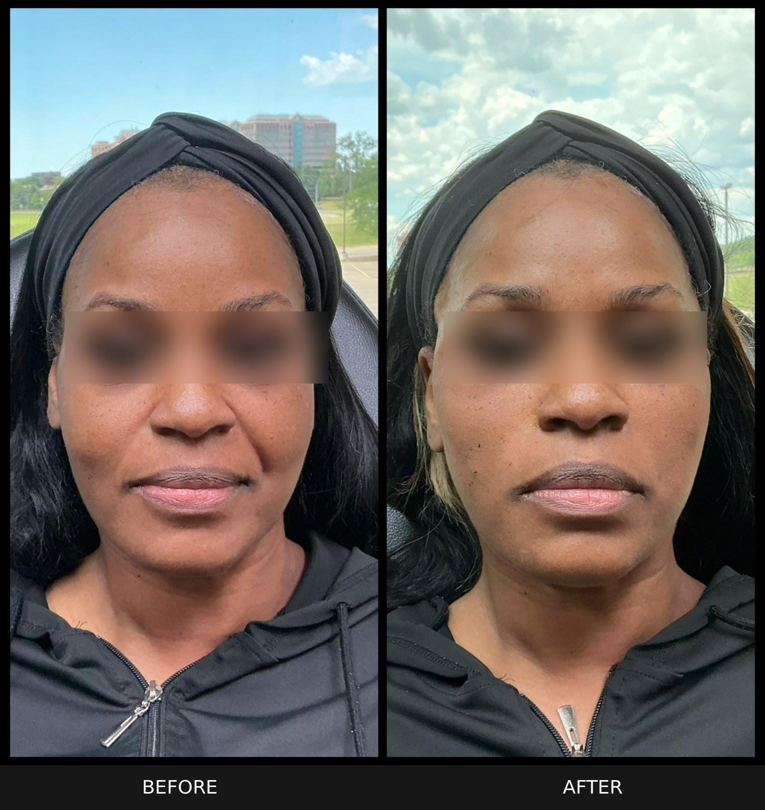 Before and after PDO thread lift comparison showing lower face and jawline definition