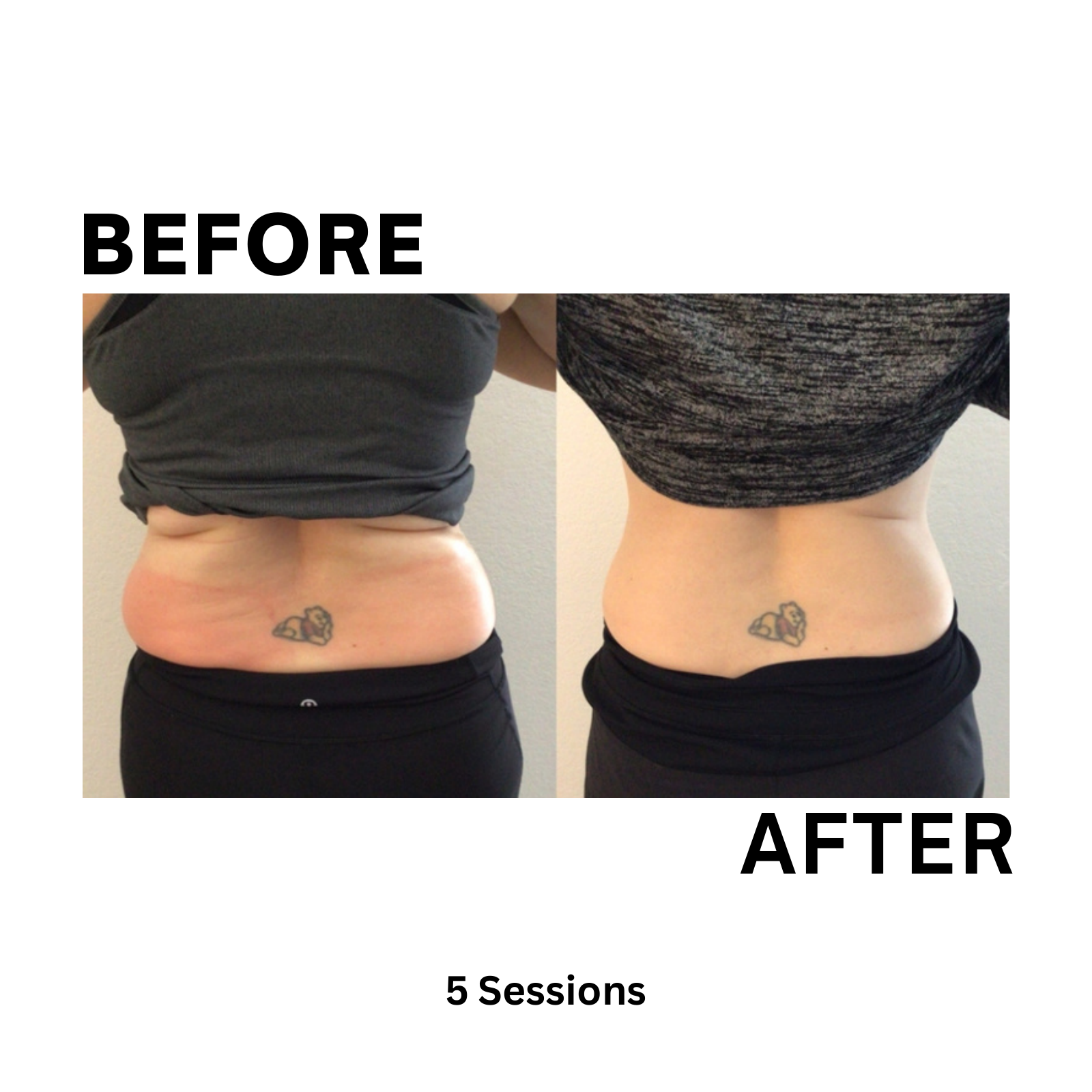 Elite MD Wellness Before and After - 5 Sessions Lower Back and Flank Contouring