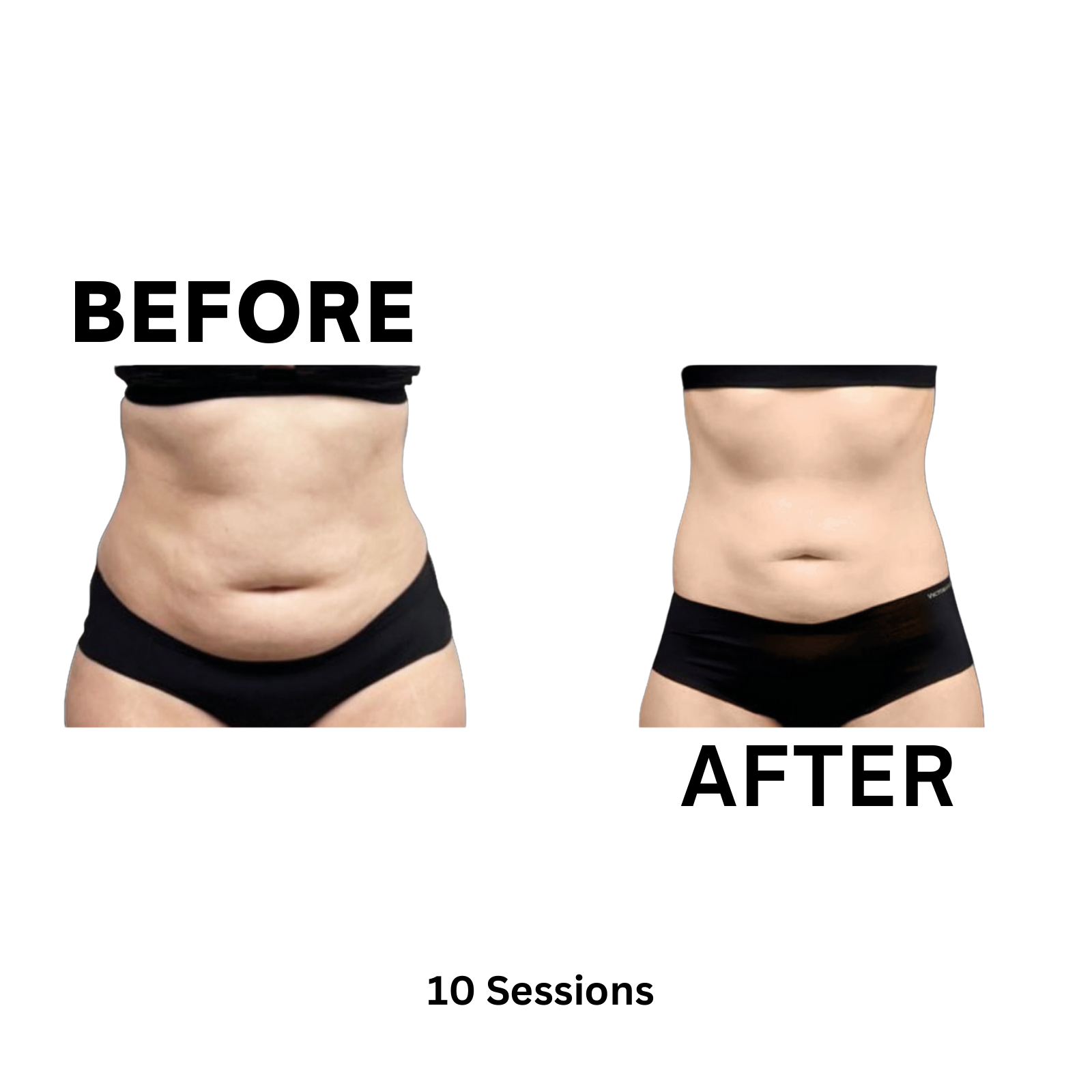 Elite MD Wellness Before and After - 10 Sessions Stomach Fat Reduction