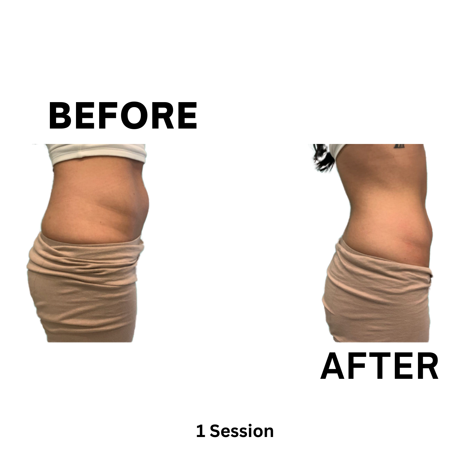 Elite MD Wellness Before and After - Real Non Surgical Lipo Result