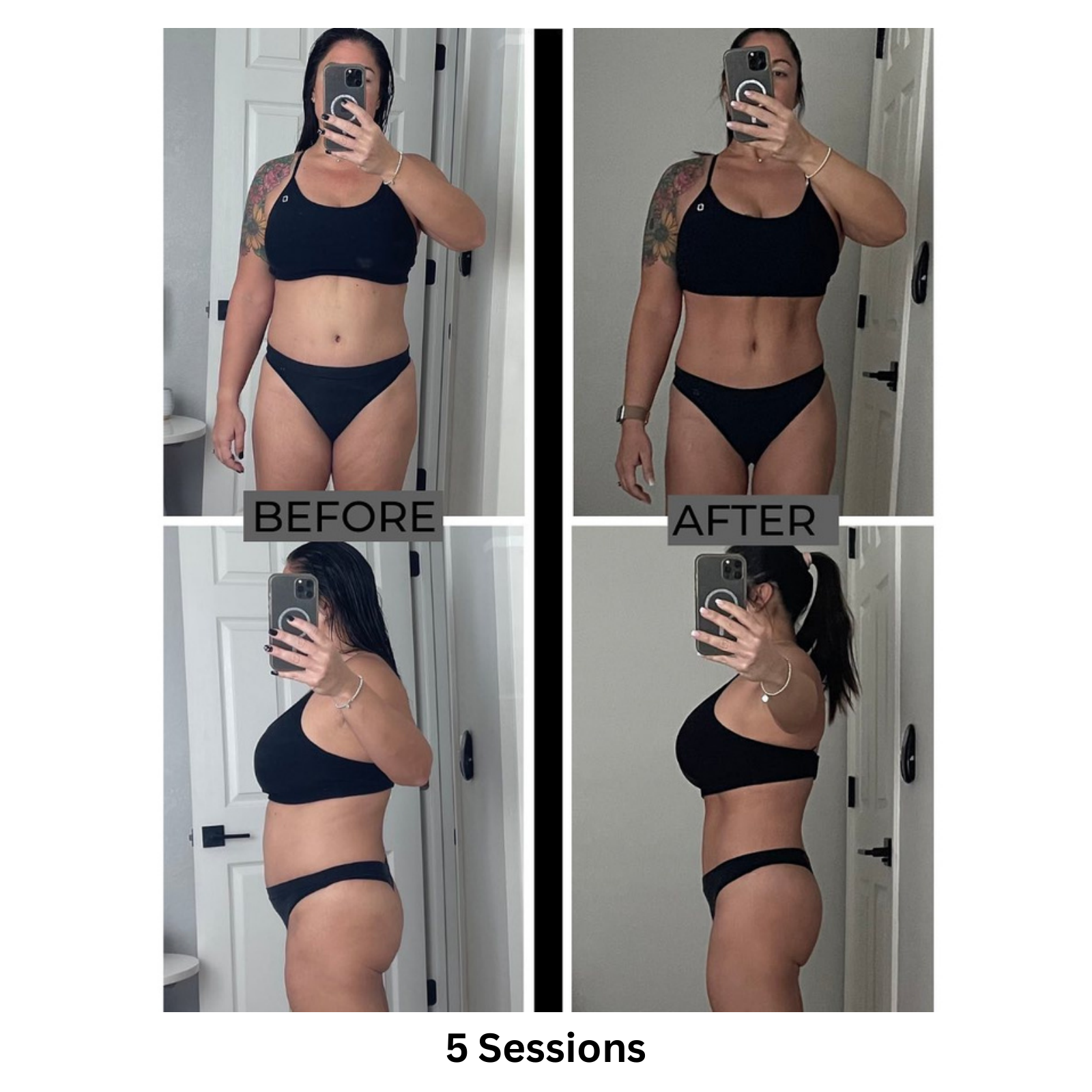 Elite MD Wellness Before and After - 5 Sessions Full Midsection Toning and Sculpting