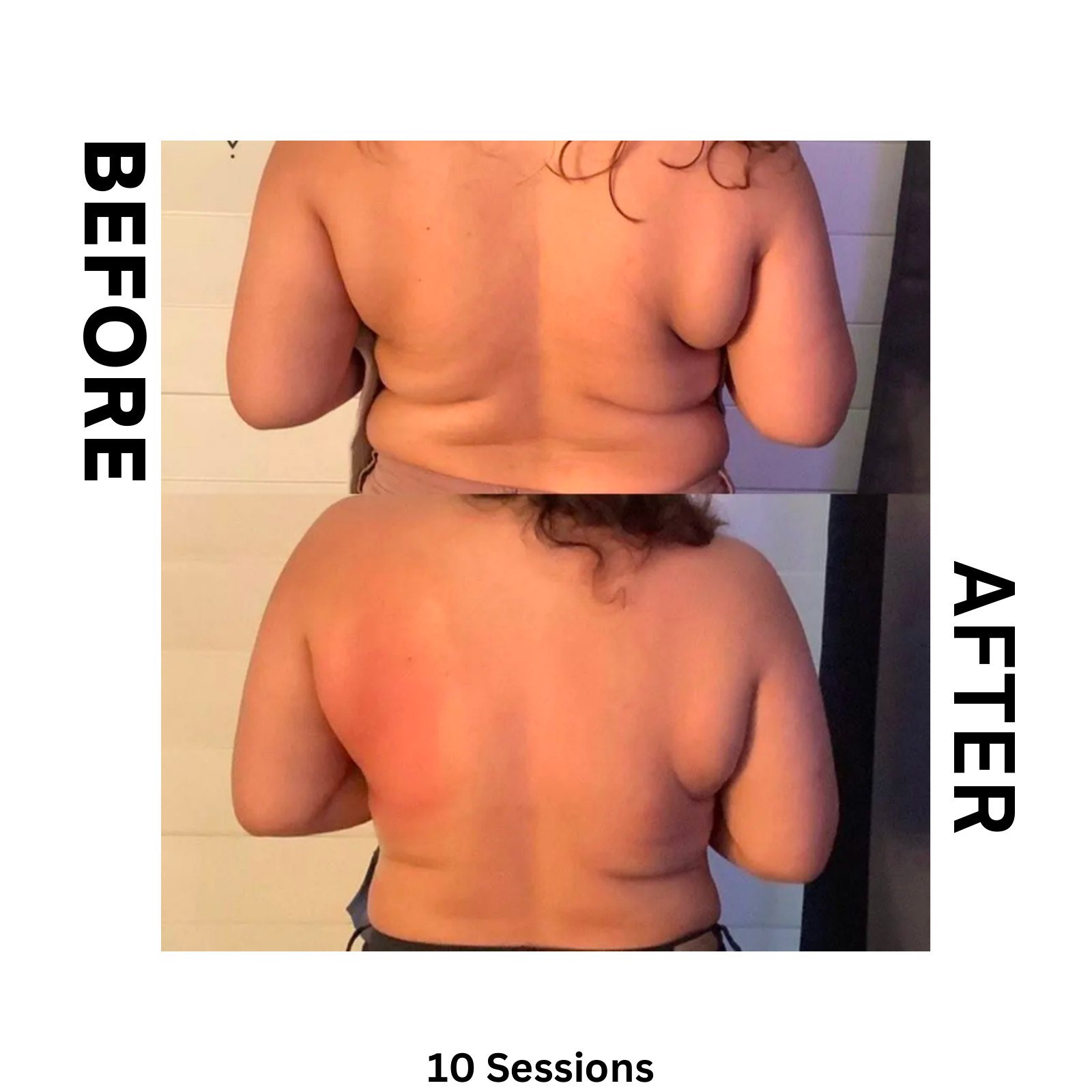 Elite MD Wellness Before and After - 10 Sessions Back Fat and Bra Line Contouring