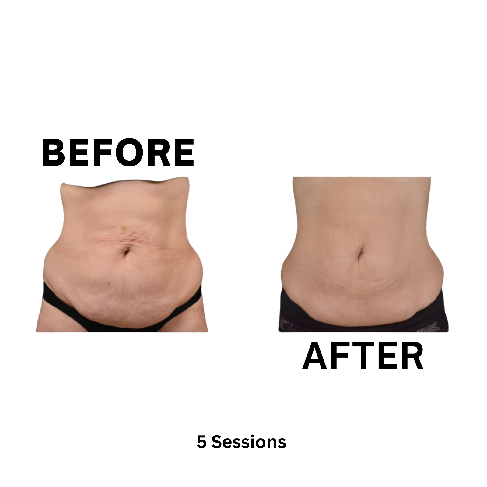 Elite MD Wellness Before and After - 5 Sessions Abdominal Skin Tightening