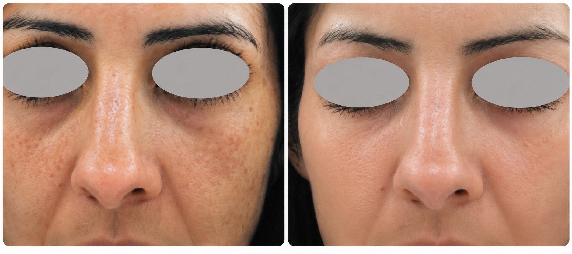 Carbon Laser Facial Before & After: Pores & Complexion comparison