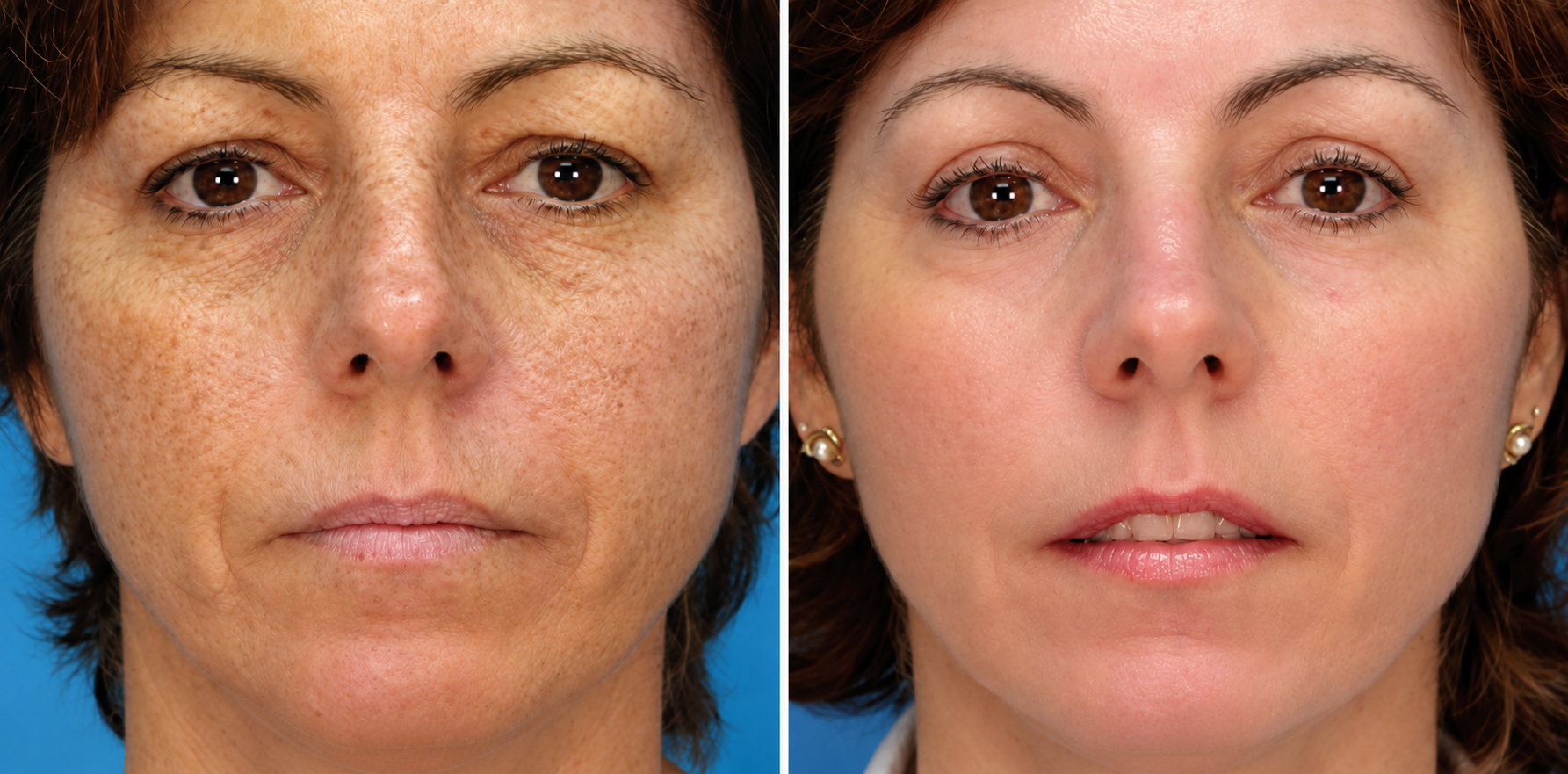 Carbon Laser Facial Before & After: Skin Texture comparison