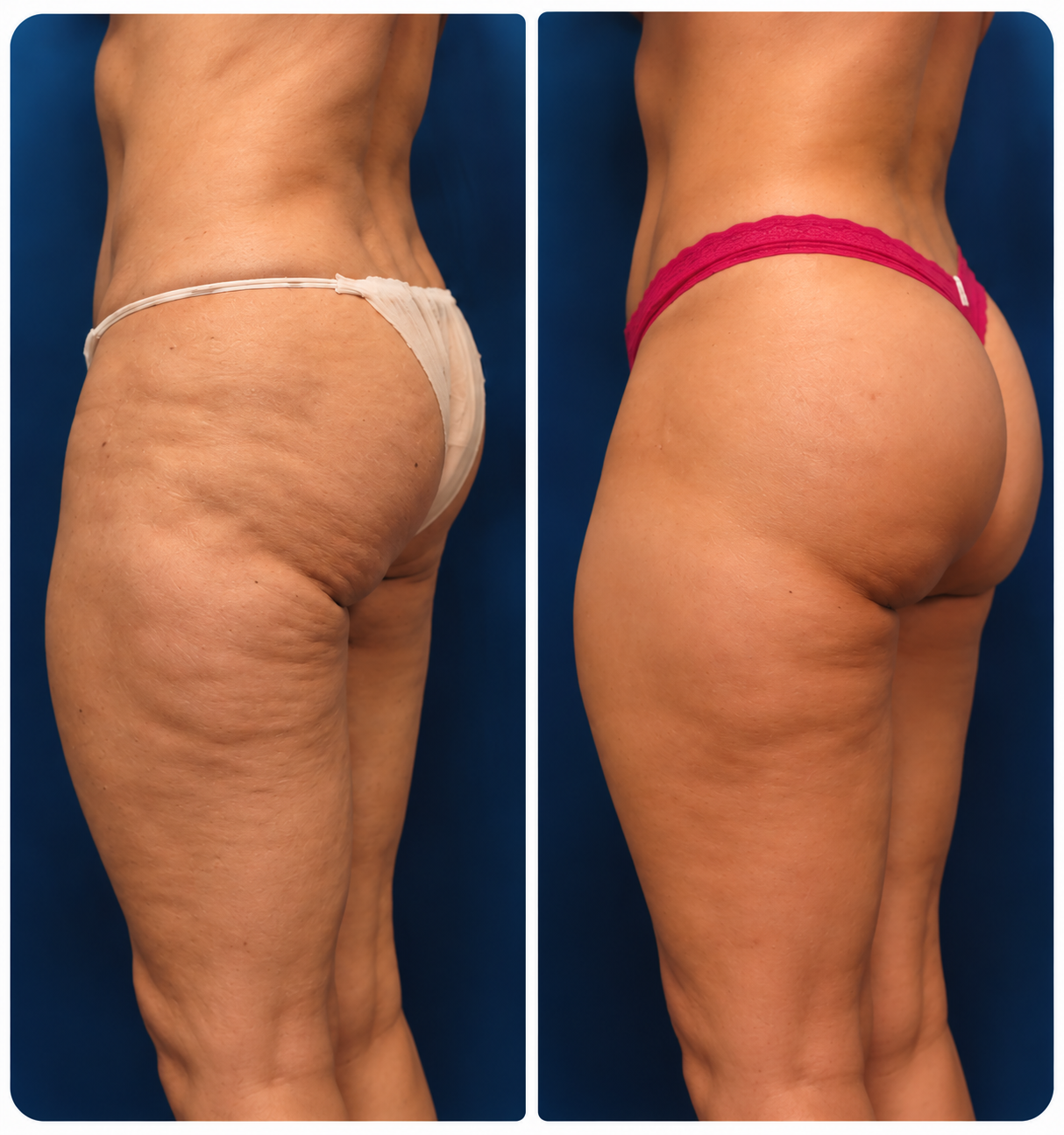 Brazilian Butt Lift Before & After: Side View comparison