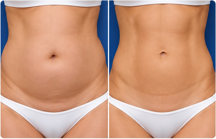 Abdominal Toning & Sculpting Before & After Comparison