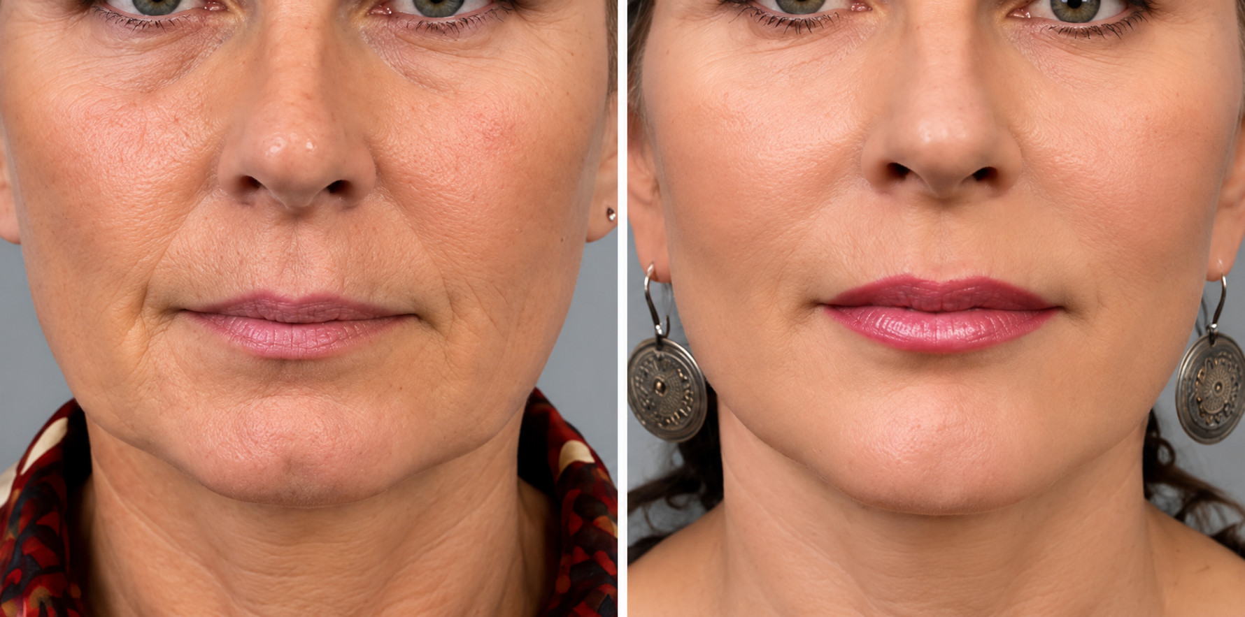3-in-1 Face Lift Before & After: Face & Cheeks comparison