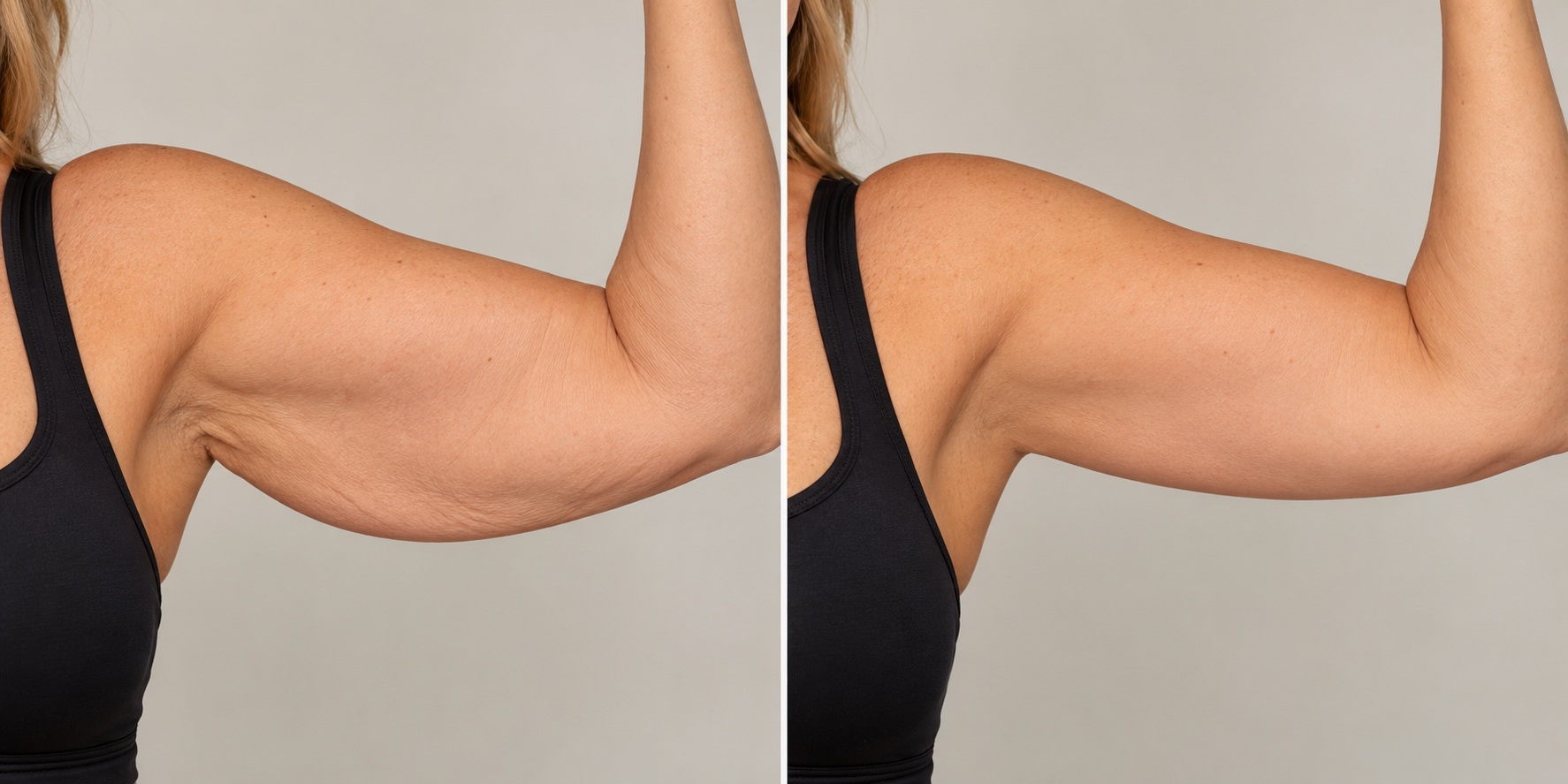 Upper Arm Tightening & Firming Before & After: comparison showing loose, crepey skin improved to a firmer, smoother contour