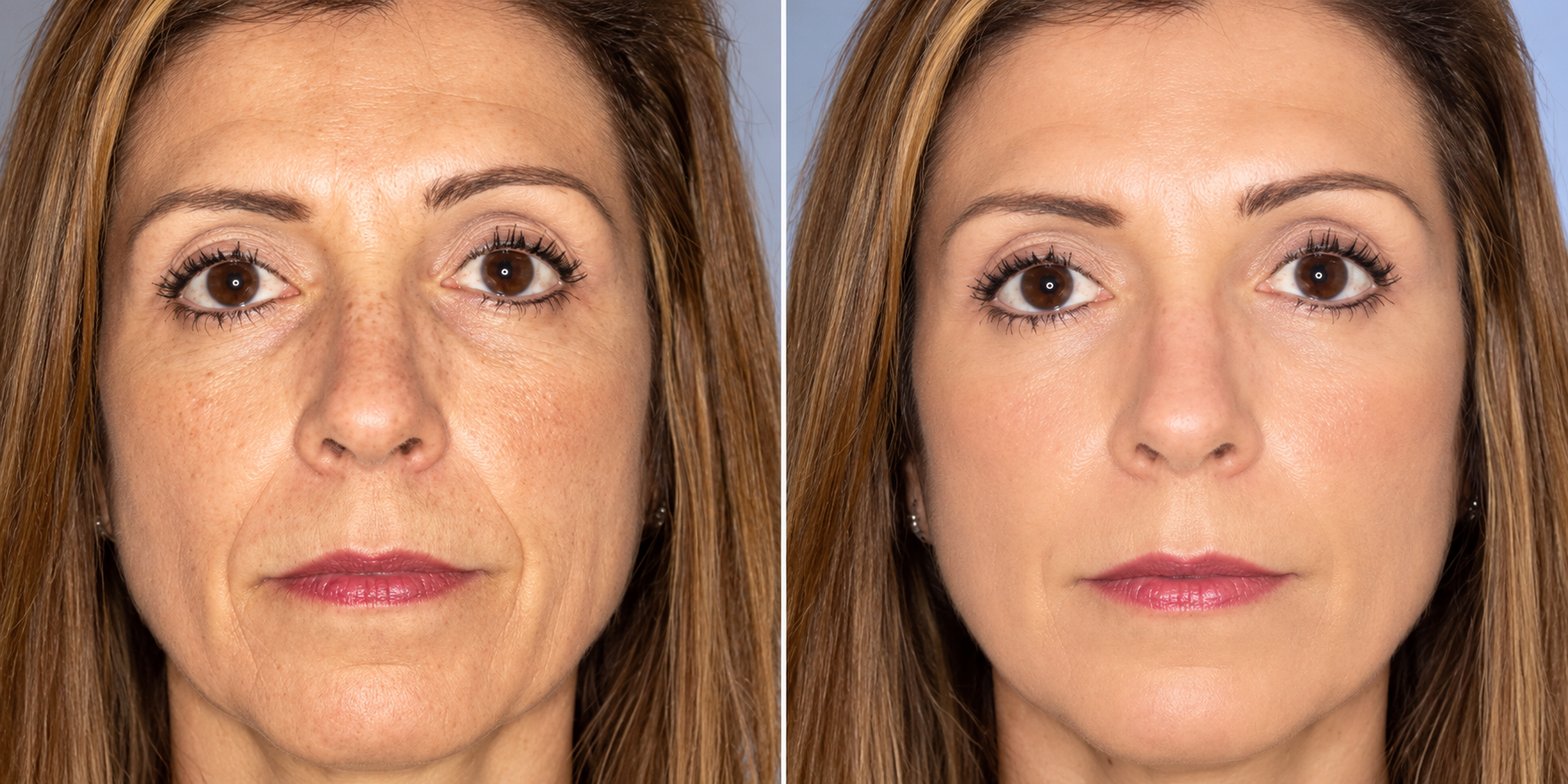 Facial Rejuvenation & Wrinkle Reduction Before & After illustrative comparison