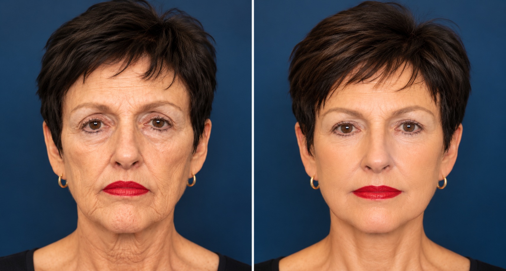 Face & Neck Rejuvenation Before & After illustrative comparison