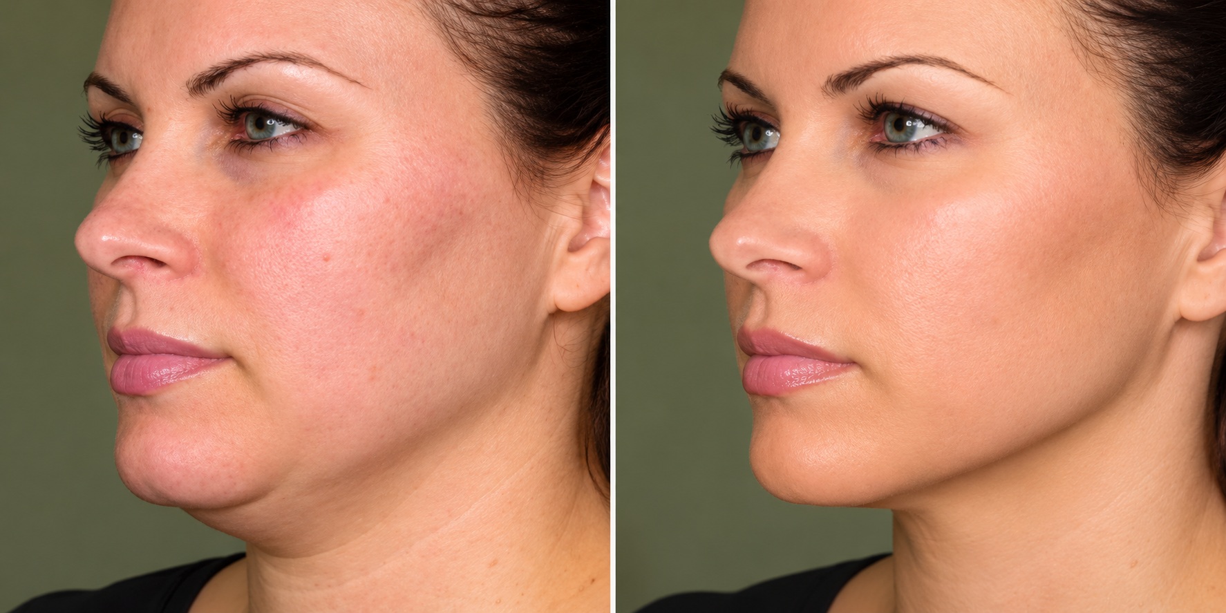 Jawline & Under-Chin Tightening Before & After illustrative comparison