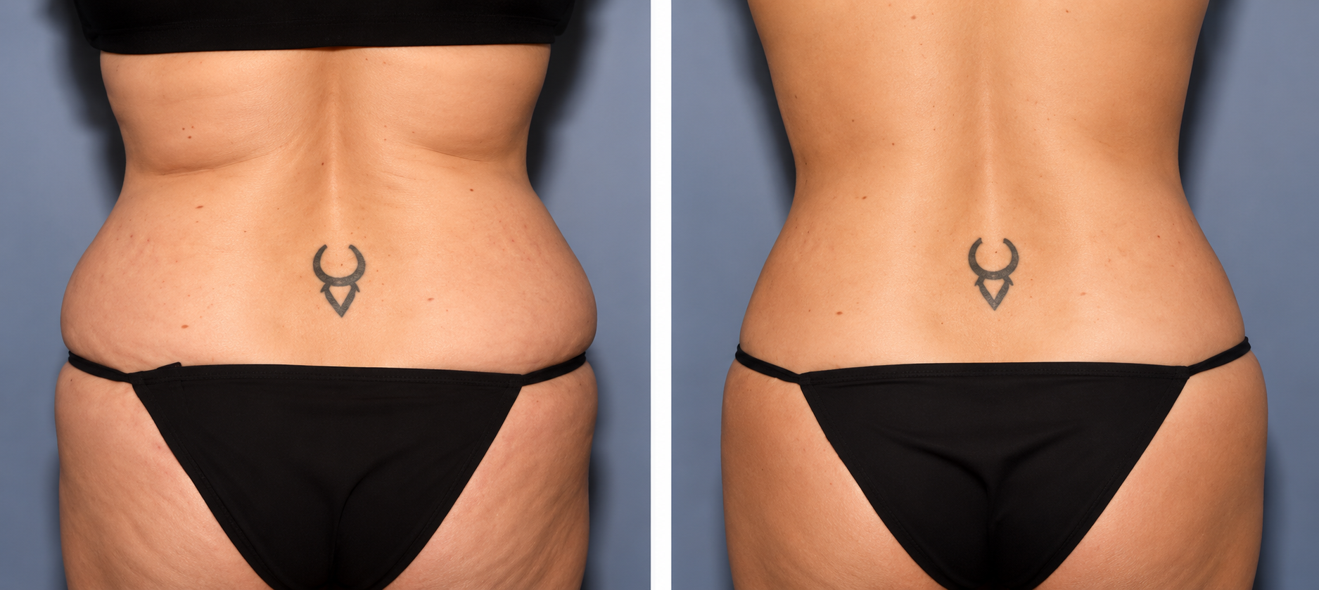 Waist and Love Handles before and after comparison showing lower back and waist
