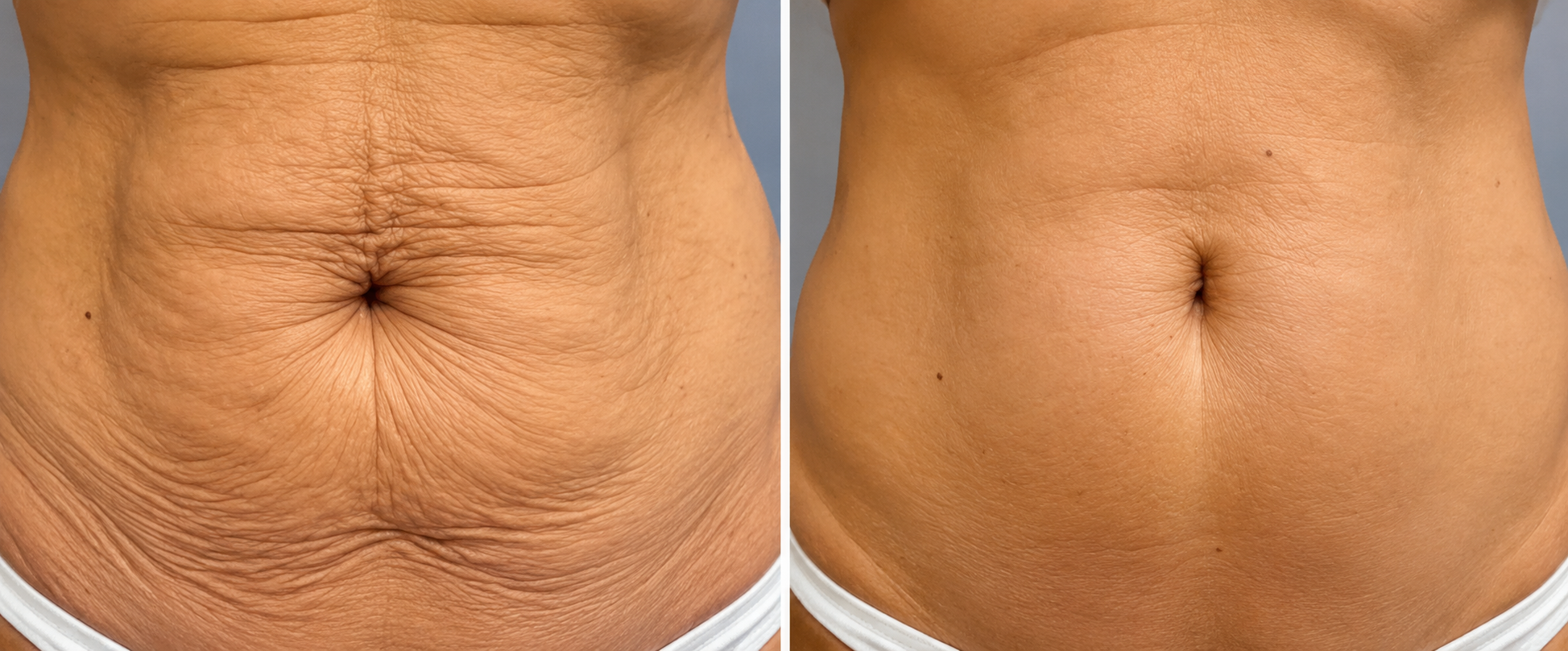 Abdominal Skin Tightening before and after comparison showing smoother skin