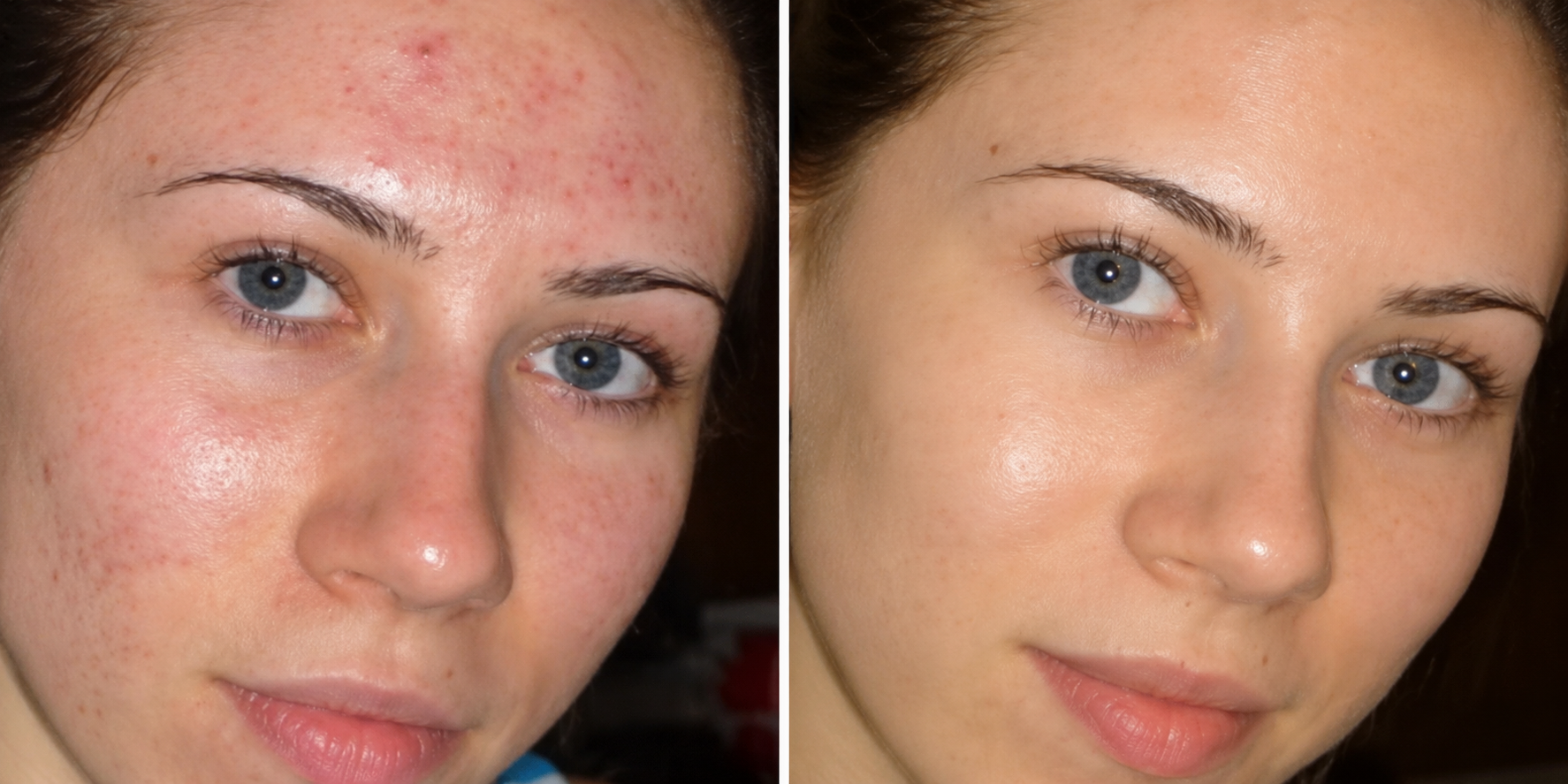 Carbon Laser Facial Before & After: Overall Skin Appearance comparison