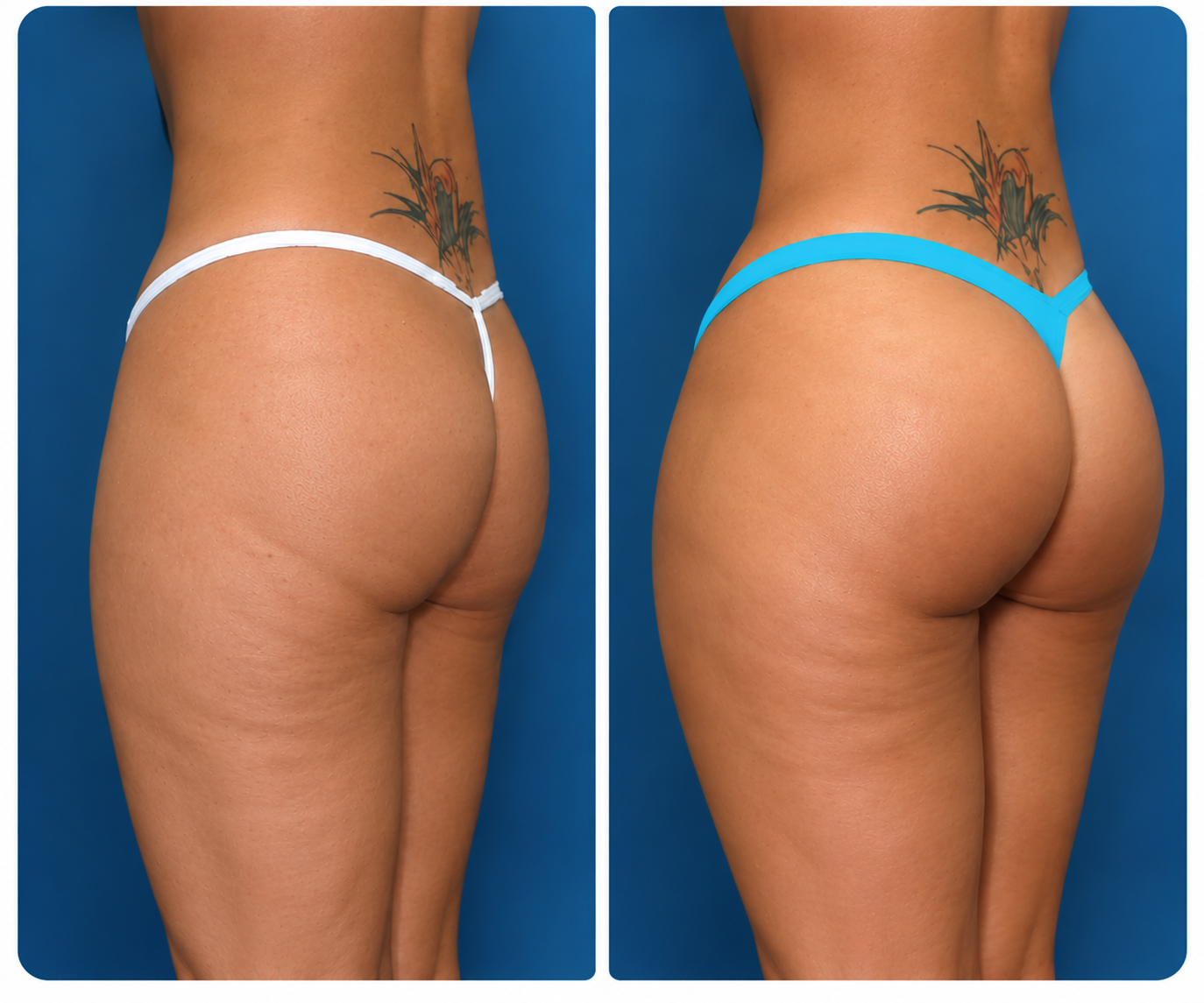 Brazilian Butt Lift Before & After: Three-Quarter View comparison