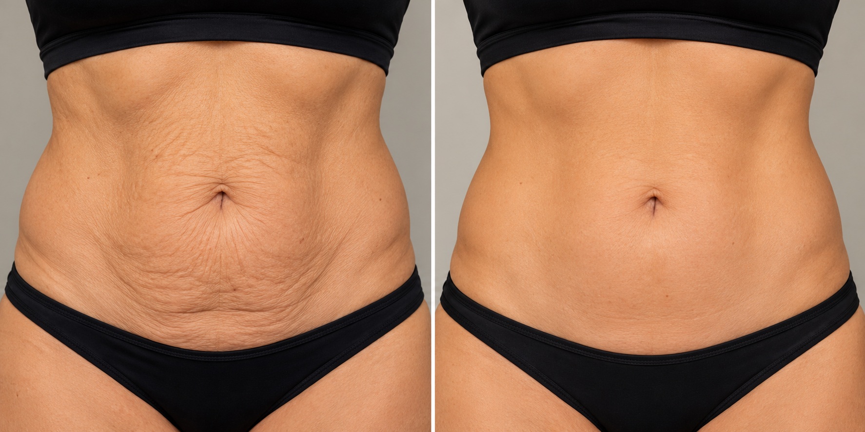 Abdominal Skin Tightening & Contouring Before & After: comparison showing loose, crepey abdominal skin improved to a smoother, firmer abdomen