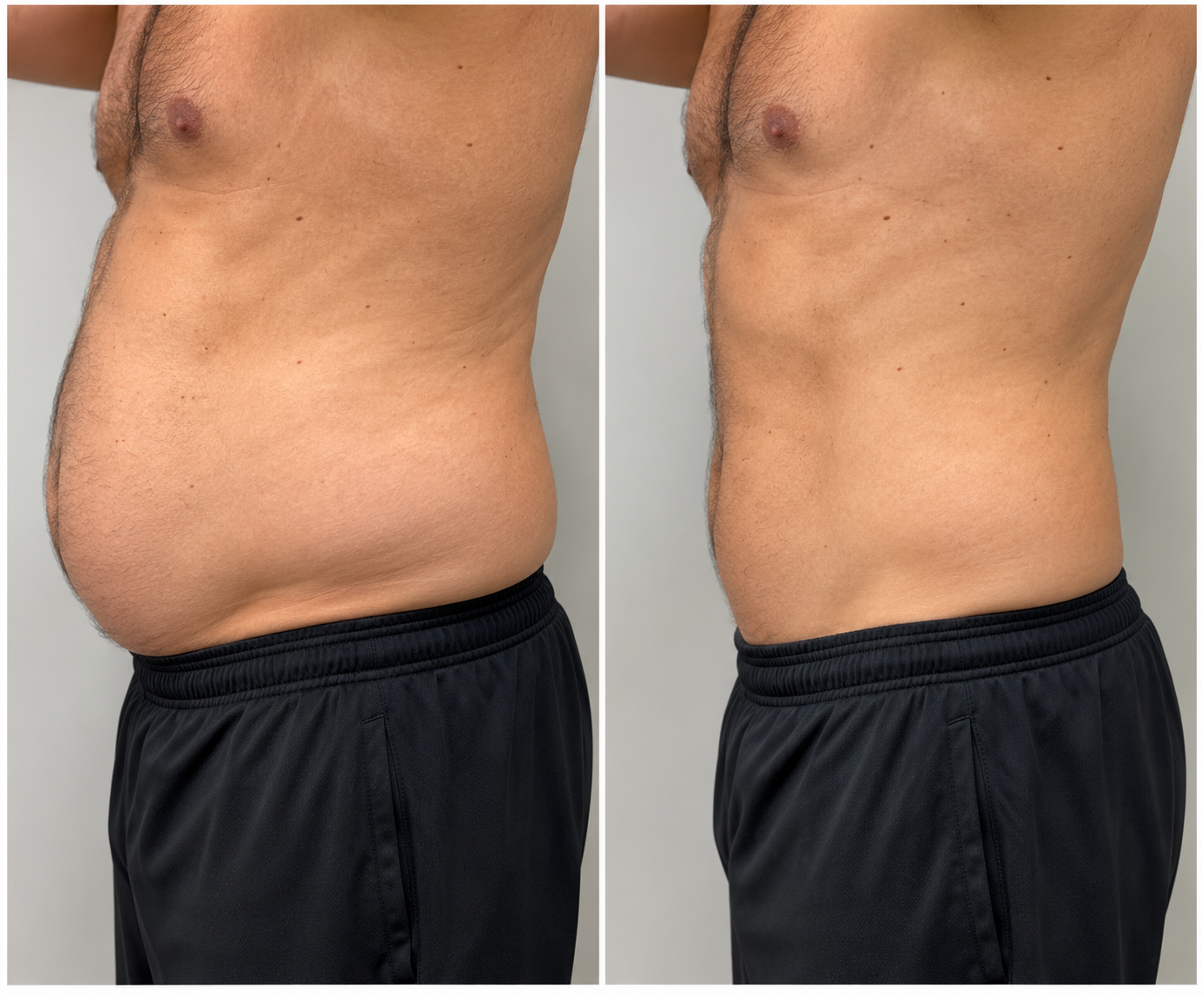 Abdominal Fat Reduction before and after comparison showing side profile