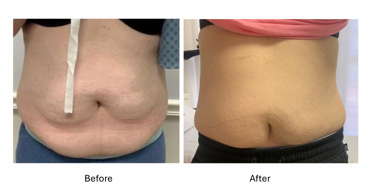 Lower Abdomen Skin Firming & Smoothing