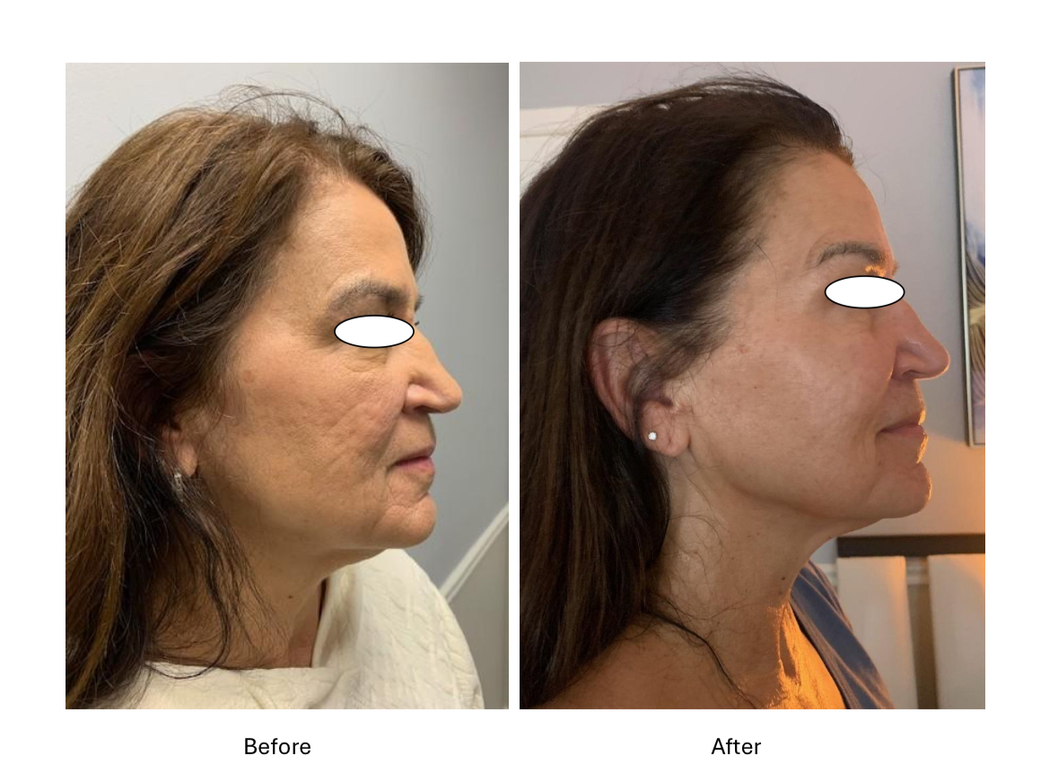 Facial Rejuvenation & Jawline Definition
