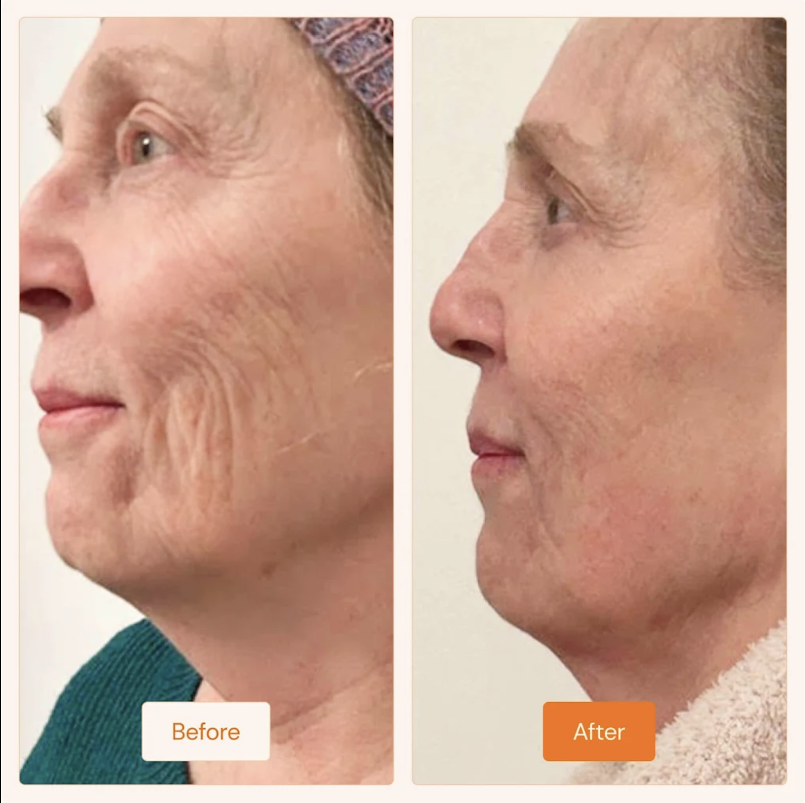 Cheek & Midface Wrinkle Smoothing