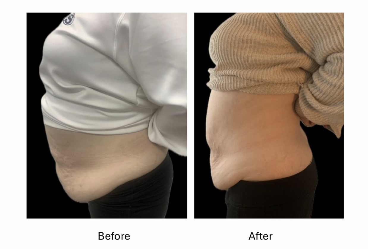 Midsection & Flank Contouring