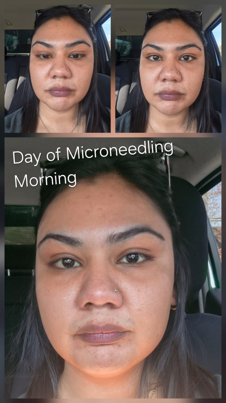 Microneedling healing Day 01 - Session Morning