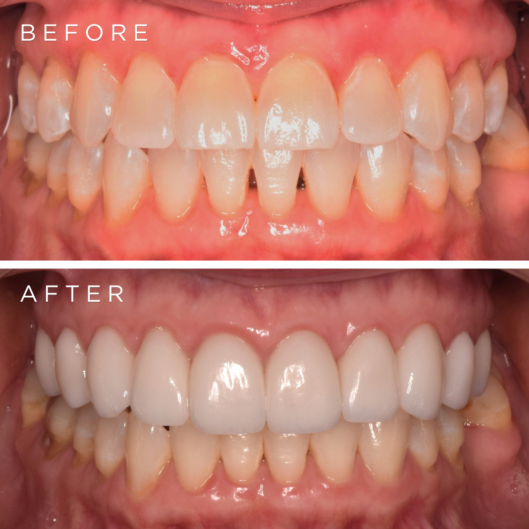 Crescent Clinics E-Max Veneers Result 2