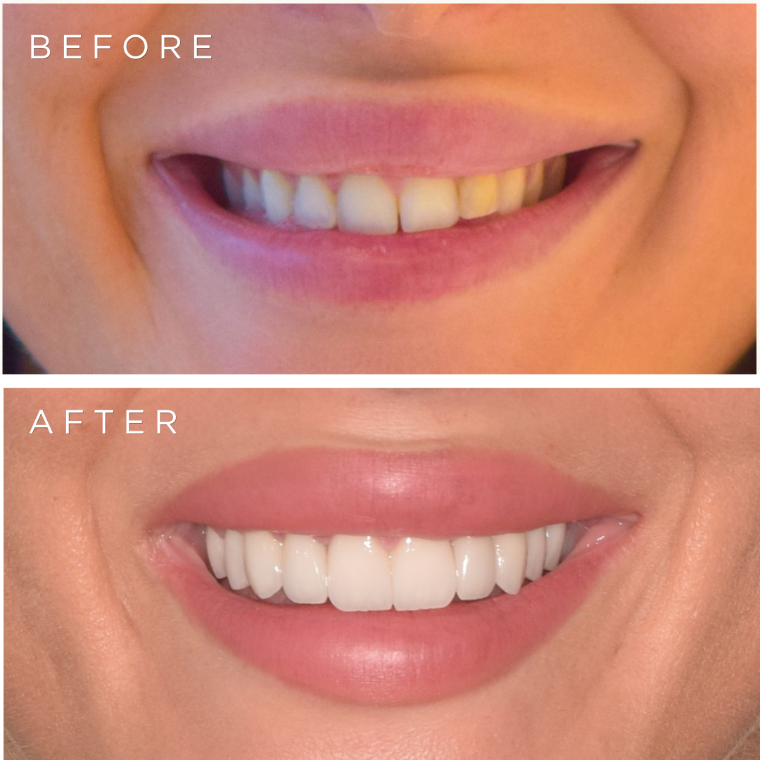 Crescent Clinics E-Max Veneers Result 4