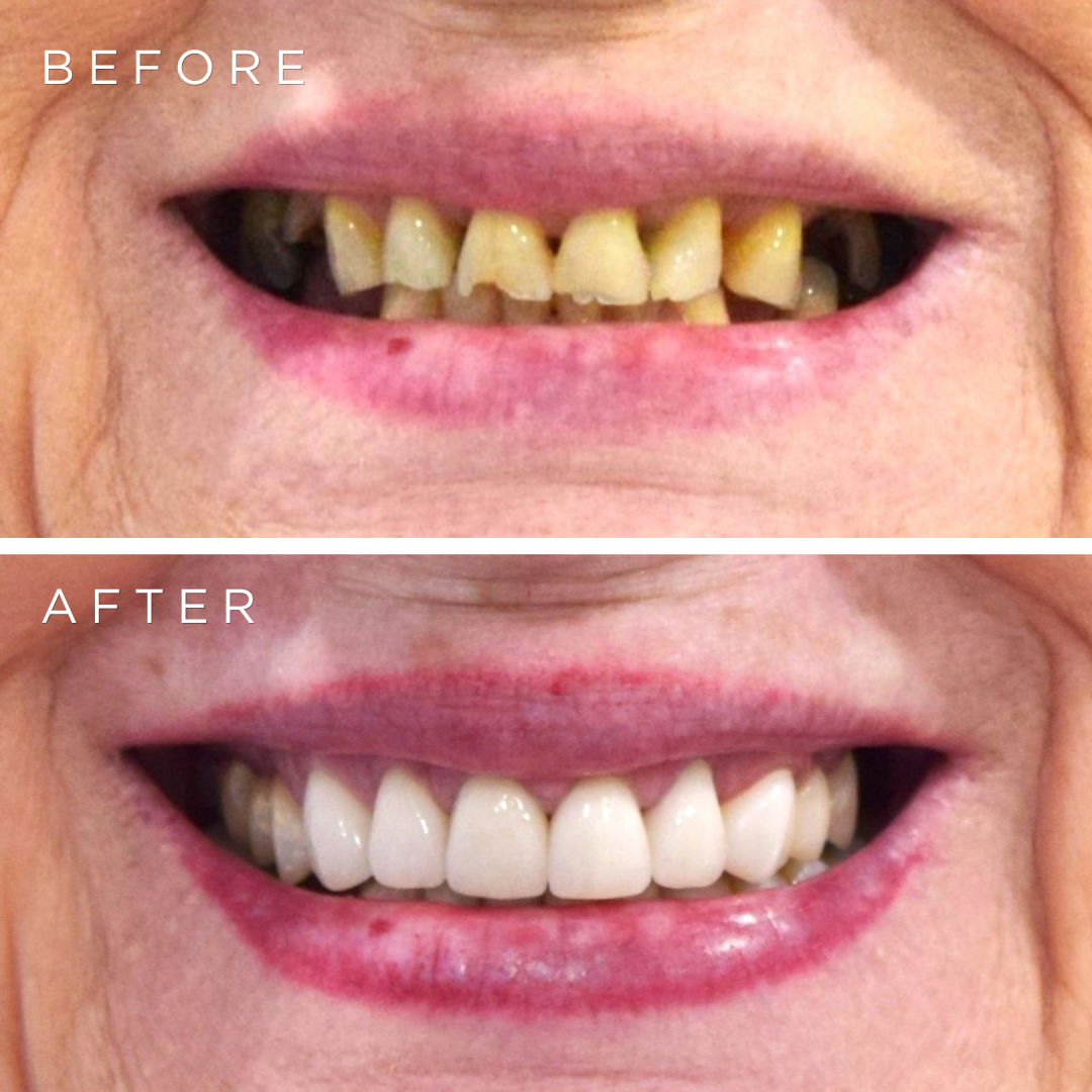 Crescent Clinics E-Max Veneers Result 1