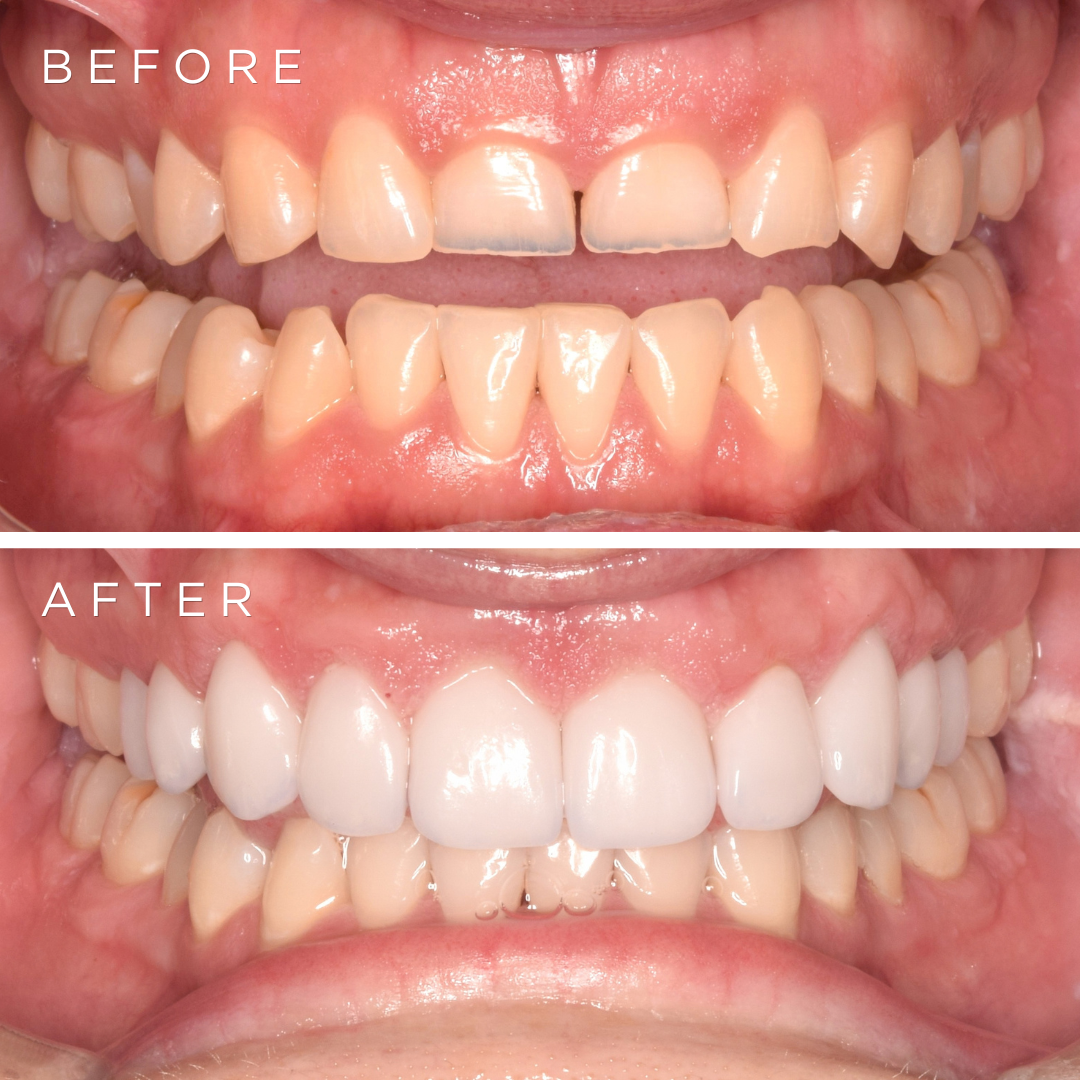 Crescent Clinics E-Max Veneers Result 3