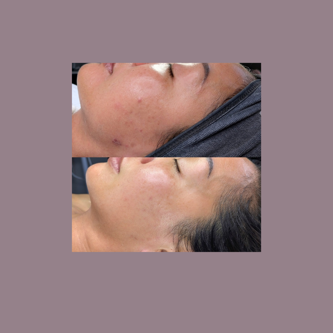 Client skin transformation at Luxe Panda Beauty