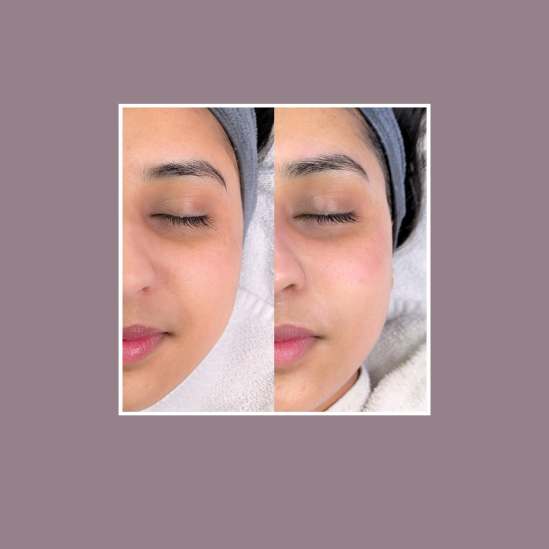 Client skin progress - real skin result