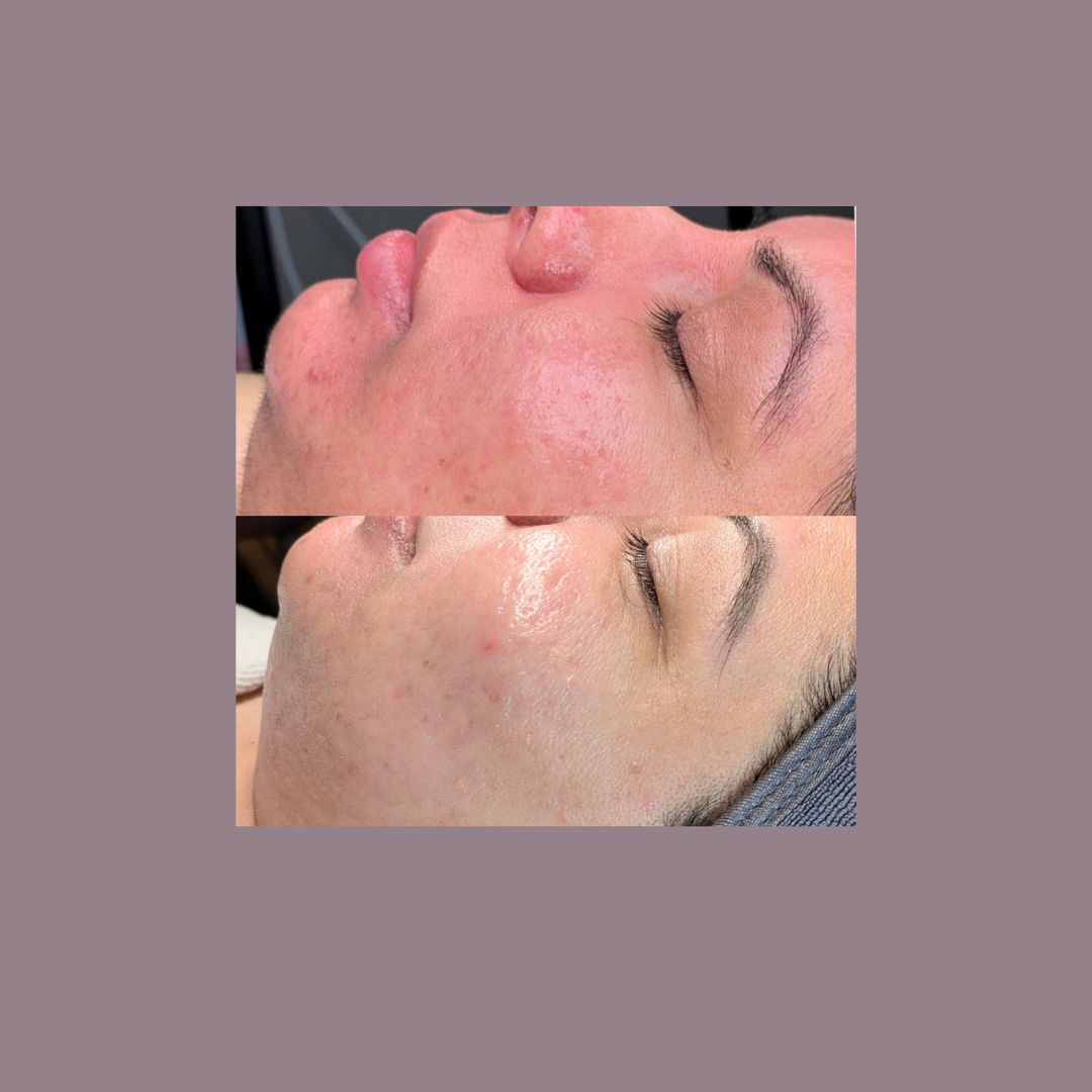 Client acne and barrier recovery journey