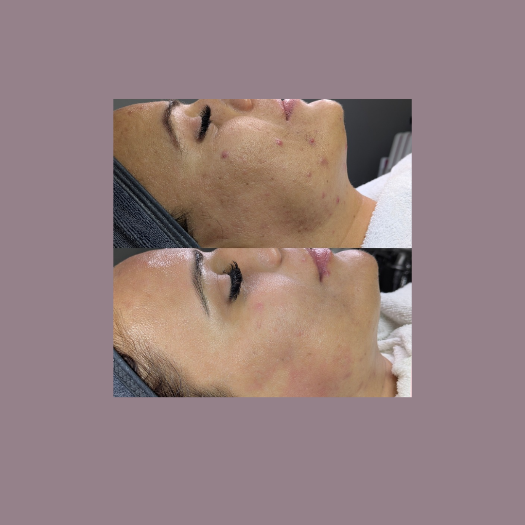 Client clear skin progress results