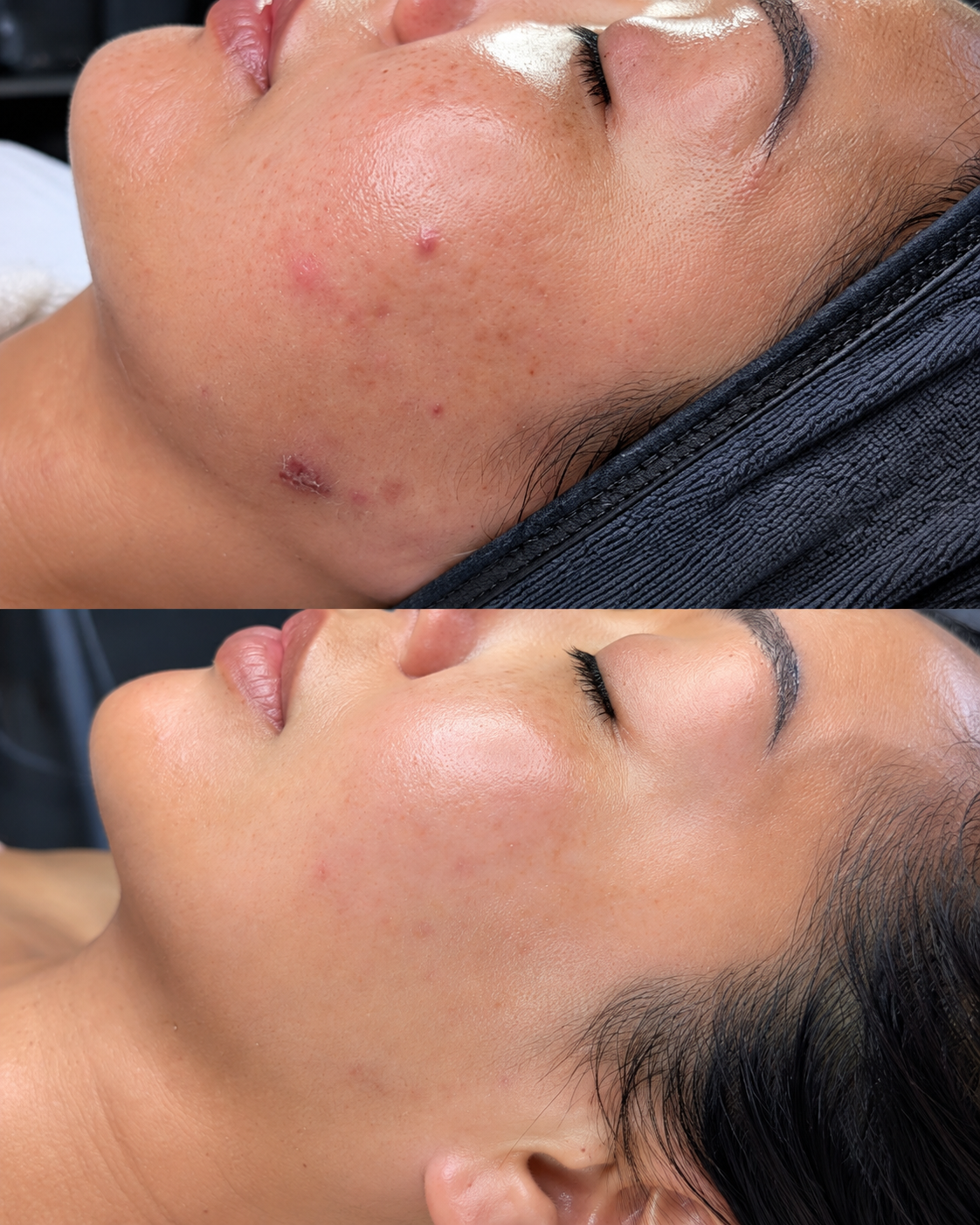Clear Skin Journey Specialized Acne Program