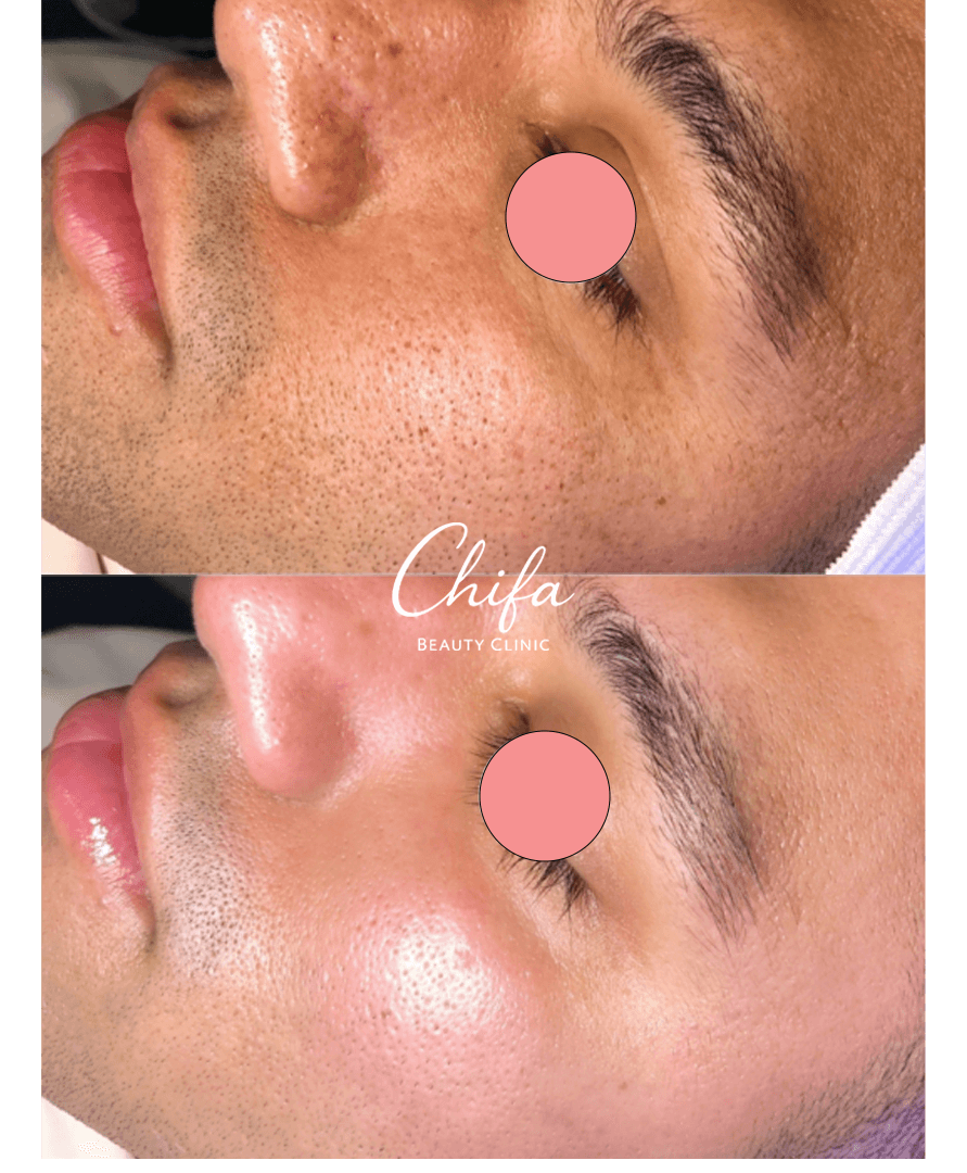 Résultat Avant Après Chifa Beauty Clinic 3