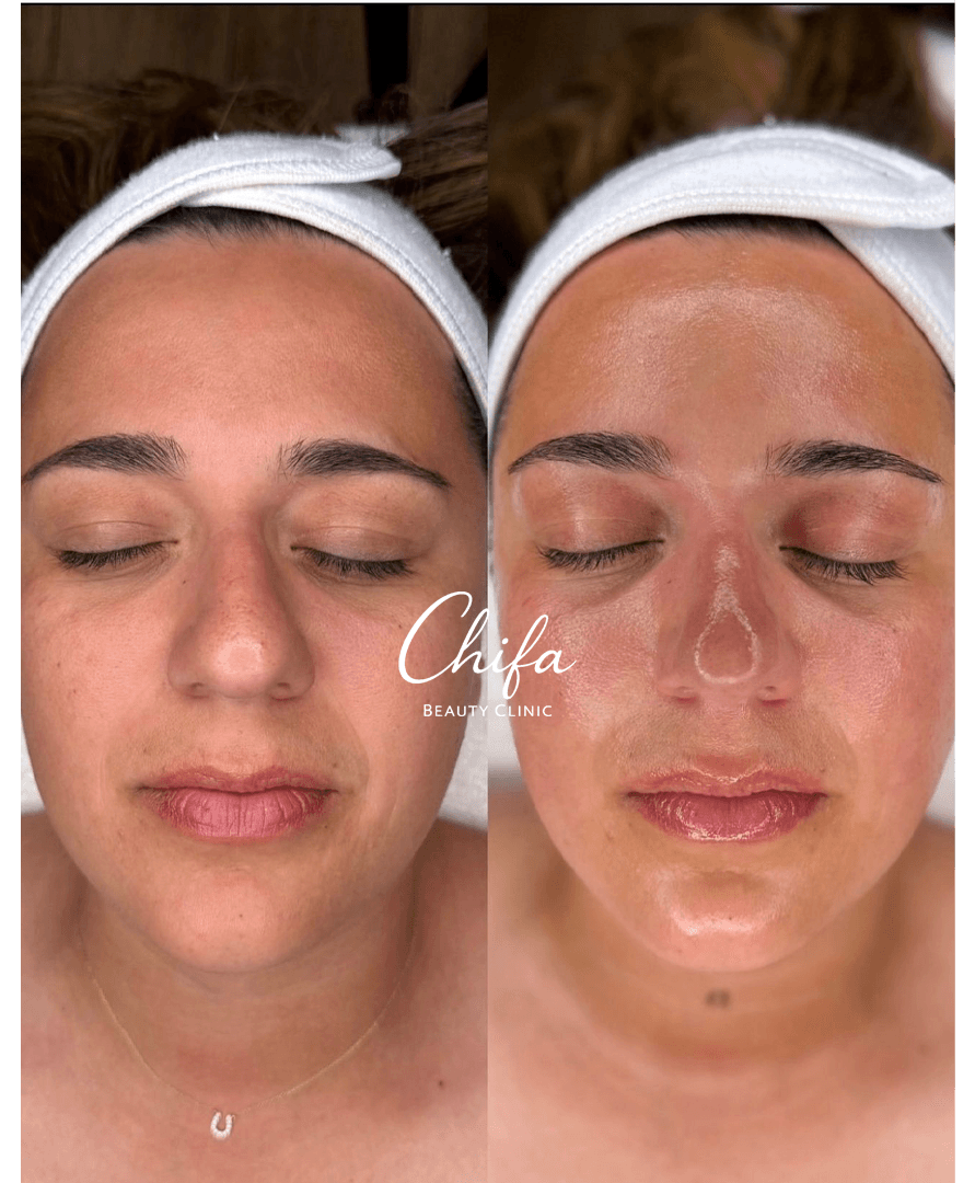 Résultat Avant Après Chifa Beauty Clinic 2