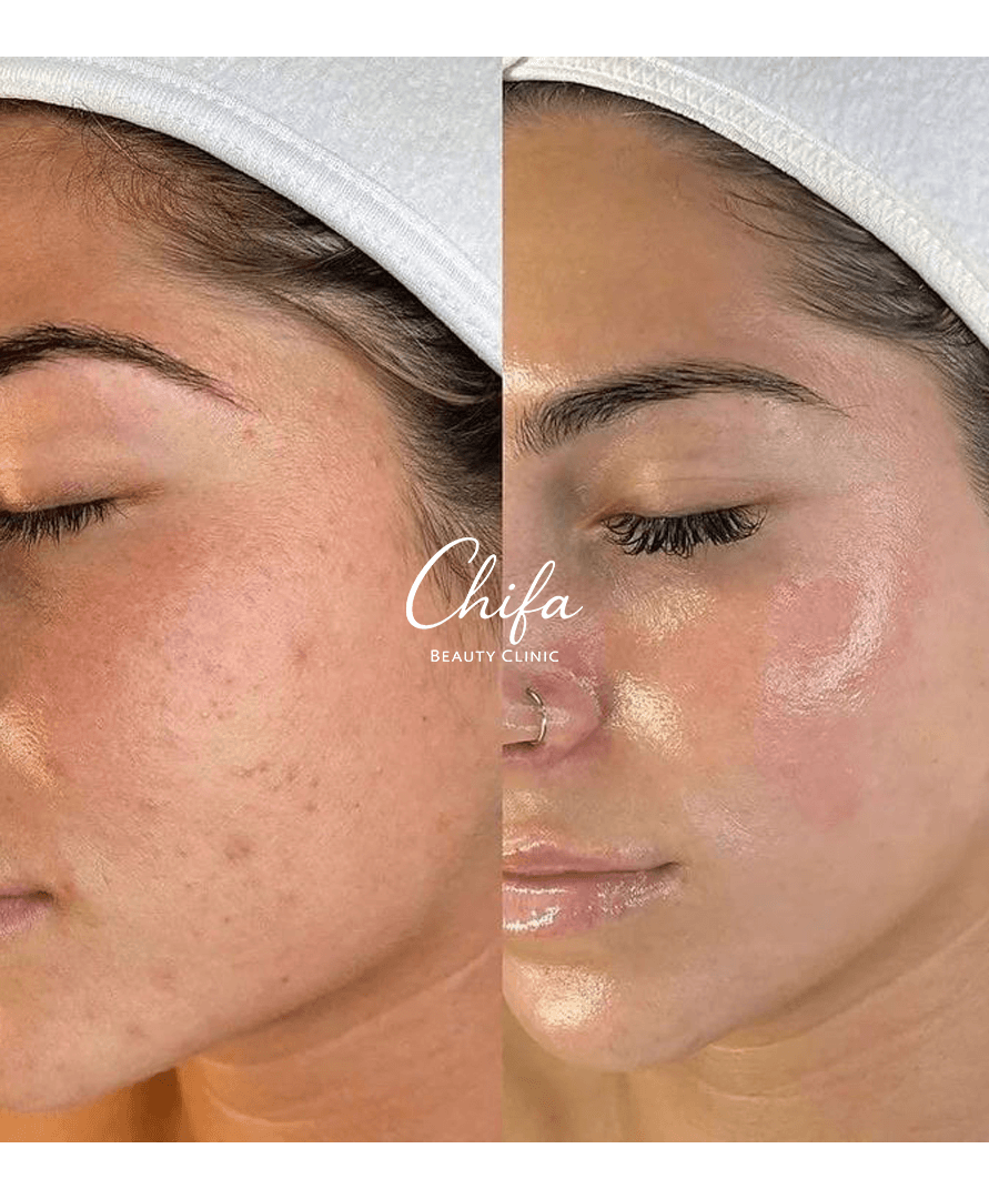 Résultat Avant Après Chifa Beauty Clinic 4