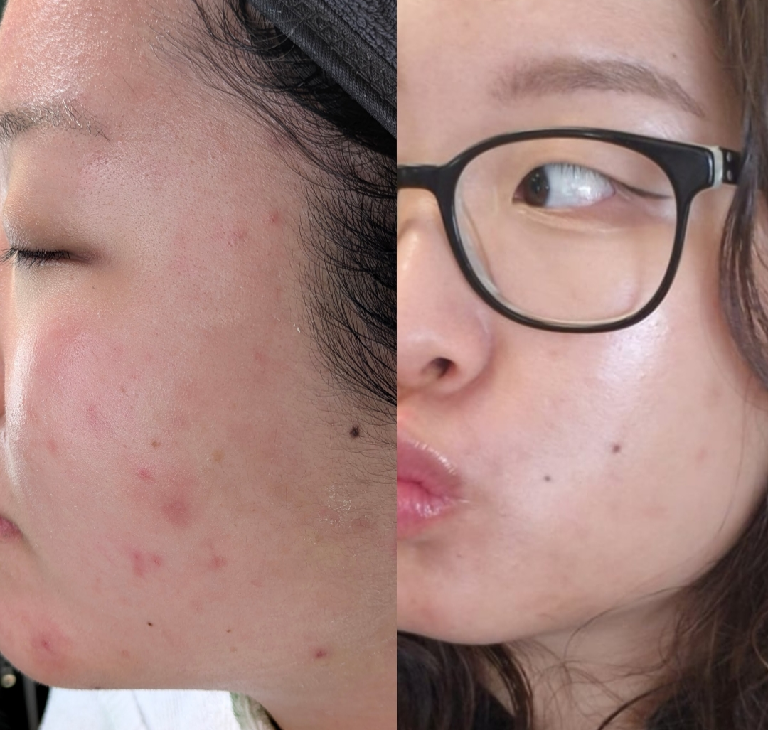 Post-Acne Clarity & Hydration — client before and after results at Luxe Panda Beauty Edmonton