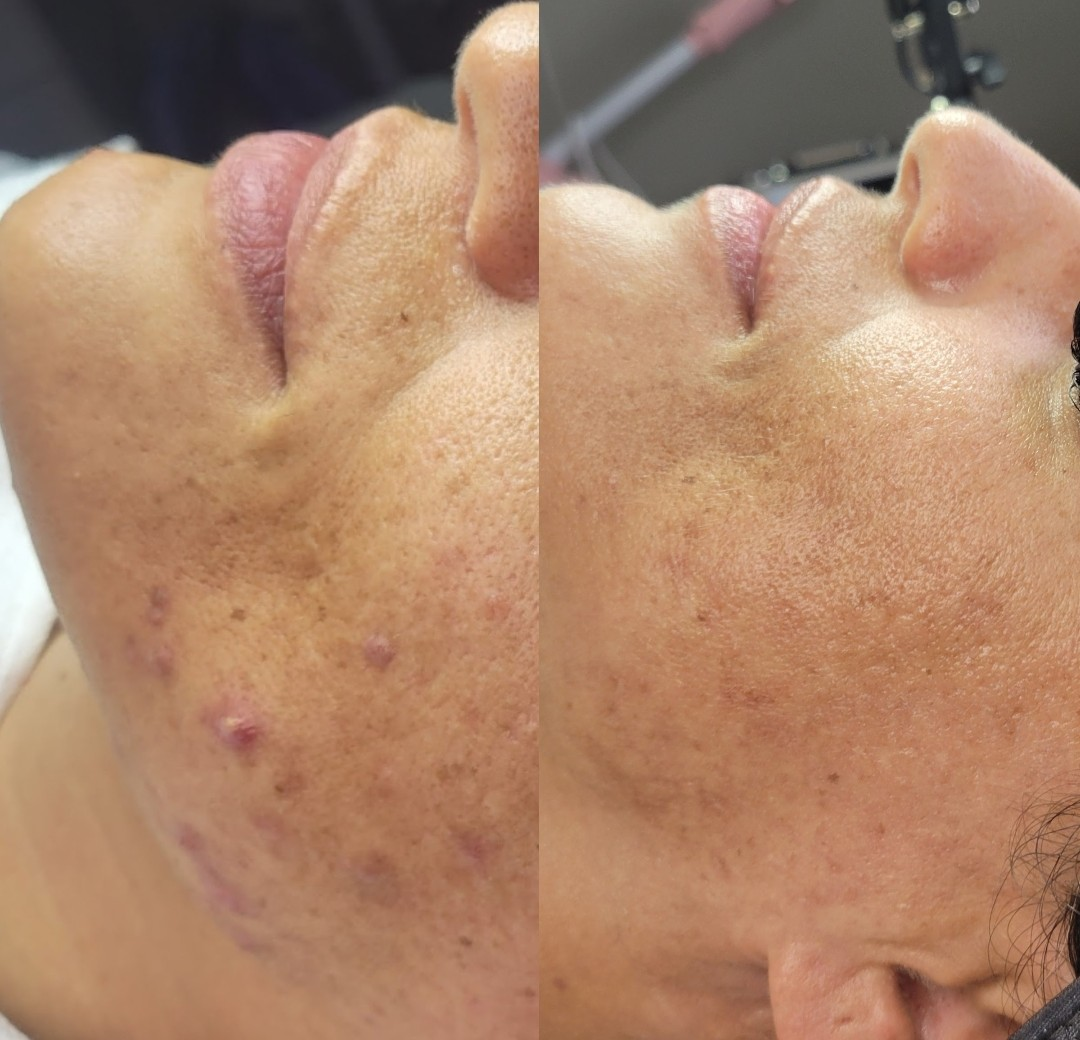 Skin Barrier Recovery & Calming — client before and after results at Luxe Panda Beauty Edmonton