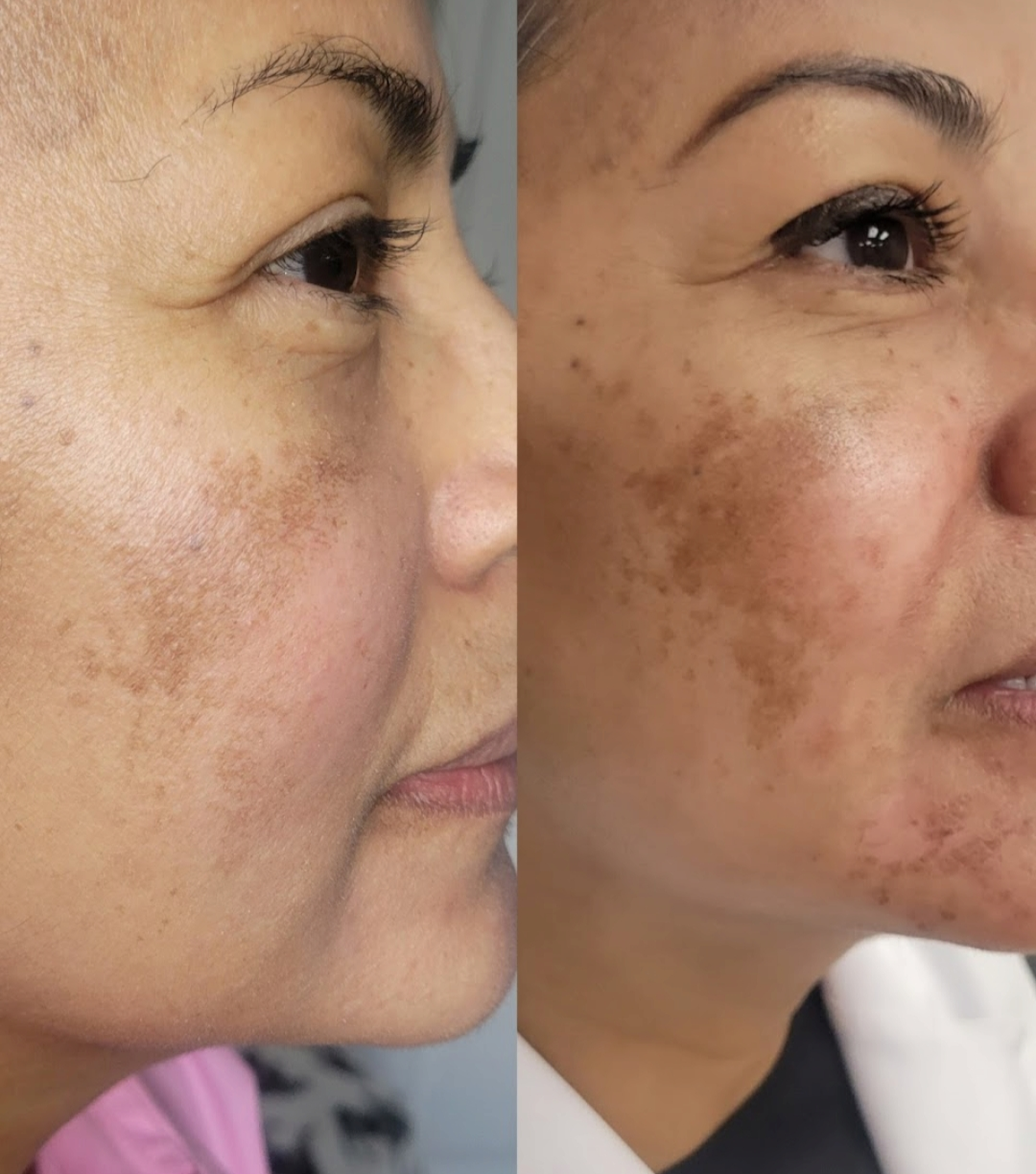 Hyperpigmentation & Sun Damage Correction — client before and after results at Luxe Panda Beauty Edmonton