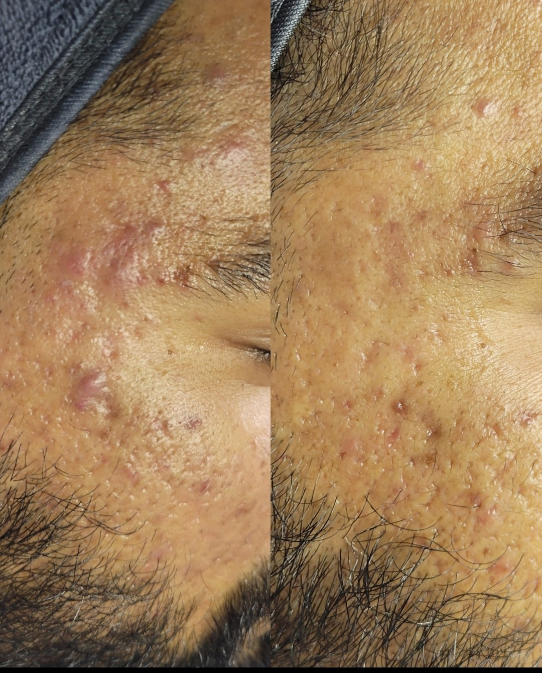 Severe Acne & Scarring Texture Refinement — client before and after results at Luxe Panda Beauty Edmonton