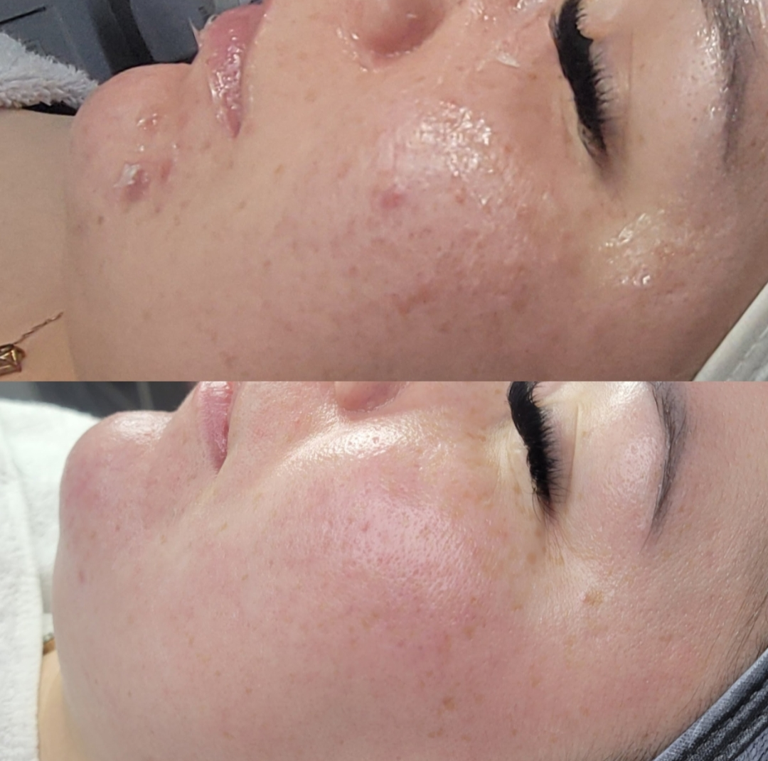 Congestion & Redness Reset — client before and after results at Luxe Panda Beauty Edmonton