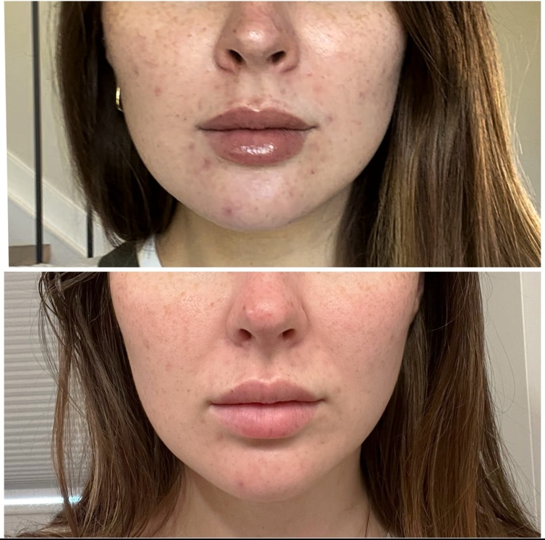 Hormonal & Lower Face Breakout Clearance — client before and after results at Luxe Panda Beauty Edmonton