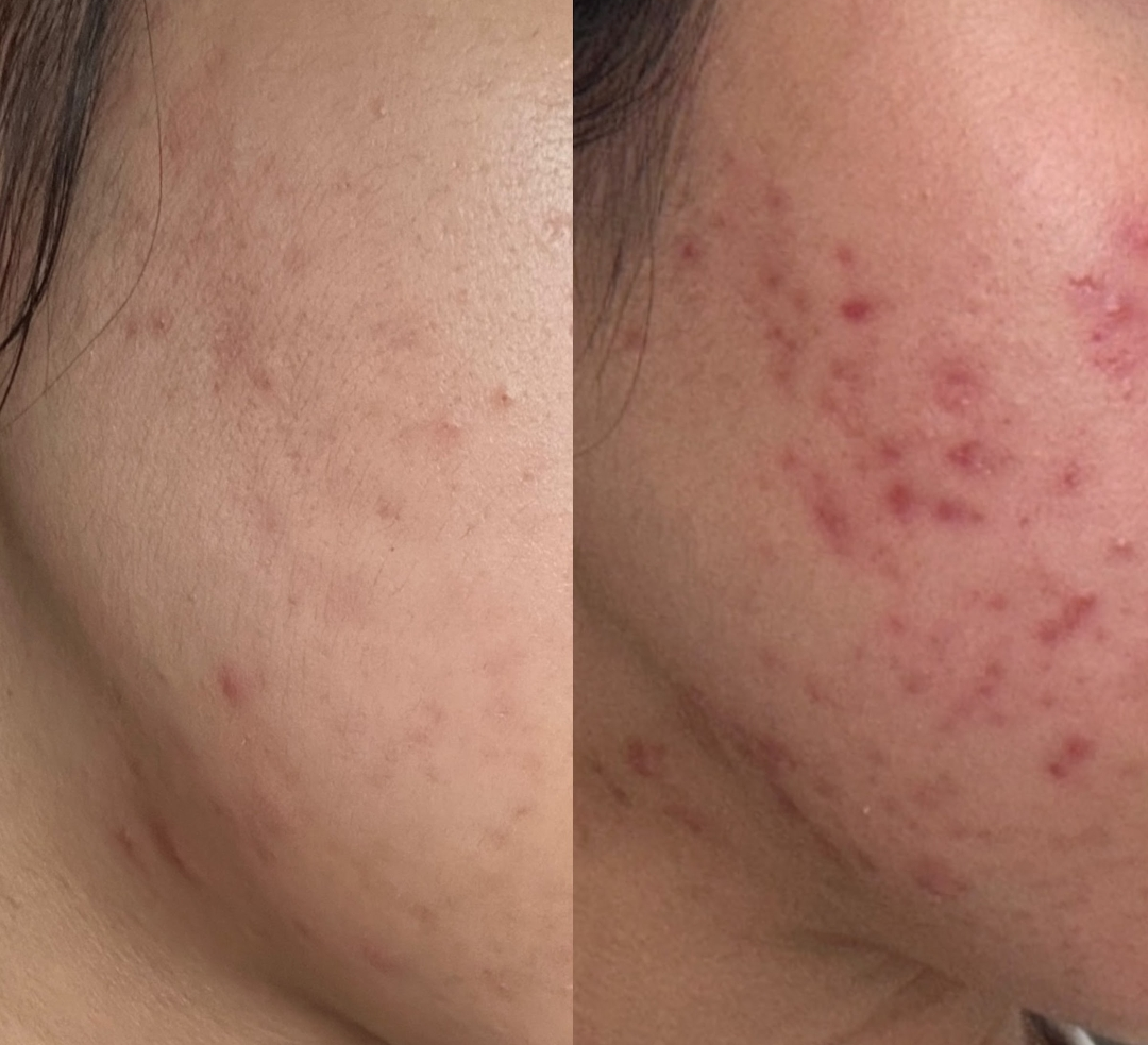 Inflammation & Breakout Calming — client before and after results at Luxe Panda Beauty Edmonton