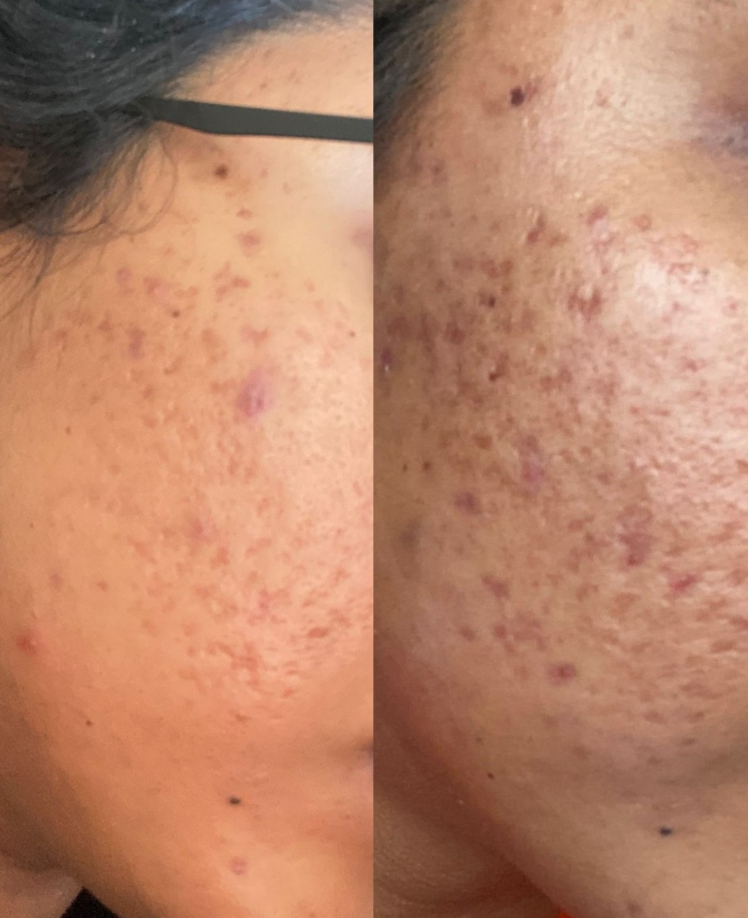 Acne & Texture Improvement — client before and after results at Luxe Panda Beauty Edmonton